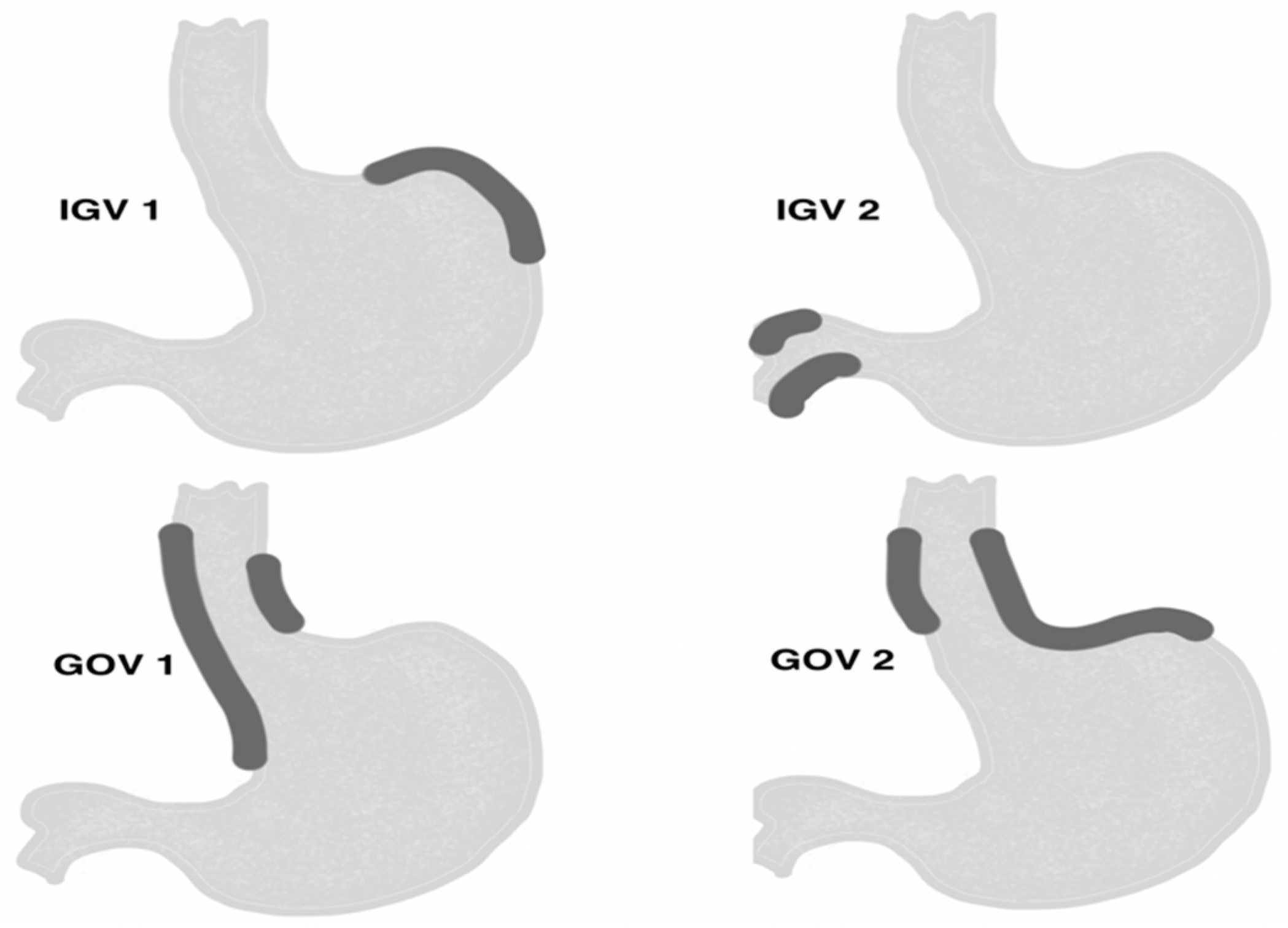JCM | Free Full-Text | Endoscopic Ultrasound-Guided Treatment of Gastric  Varices Using Coils and Cyanoacrylate Glue Injections: Results after 1 Year  of Experience