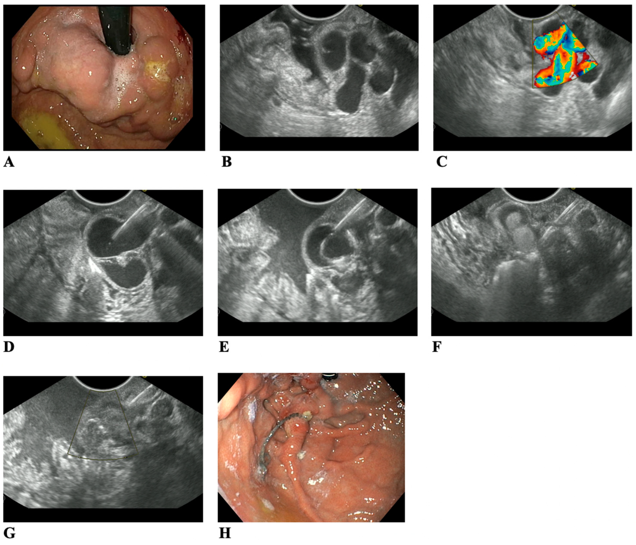 JCM Free FullText Endoscopic UltrasoundGuided Treatment of