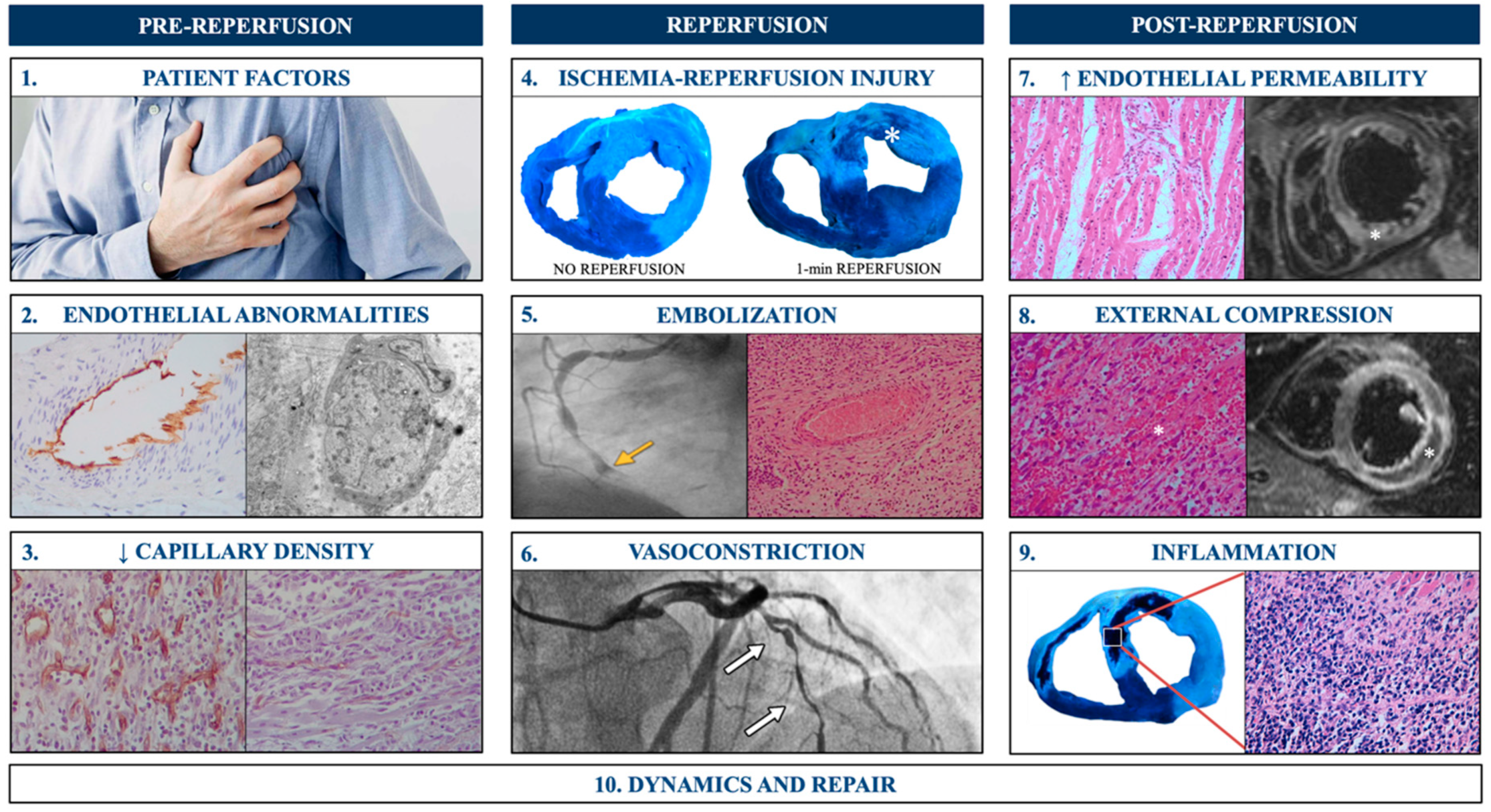 JCM Free FullText Microvascular Obstruction in STSegment Elevation Myocardial Infarction