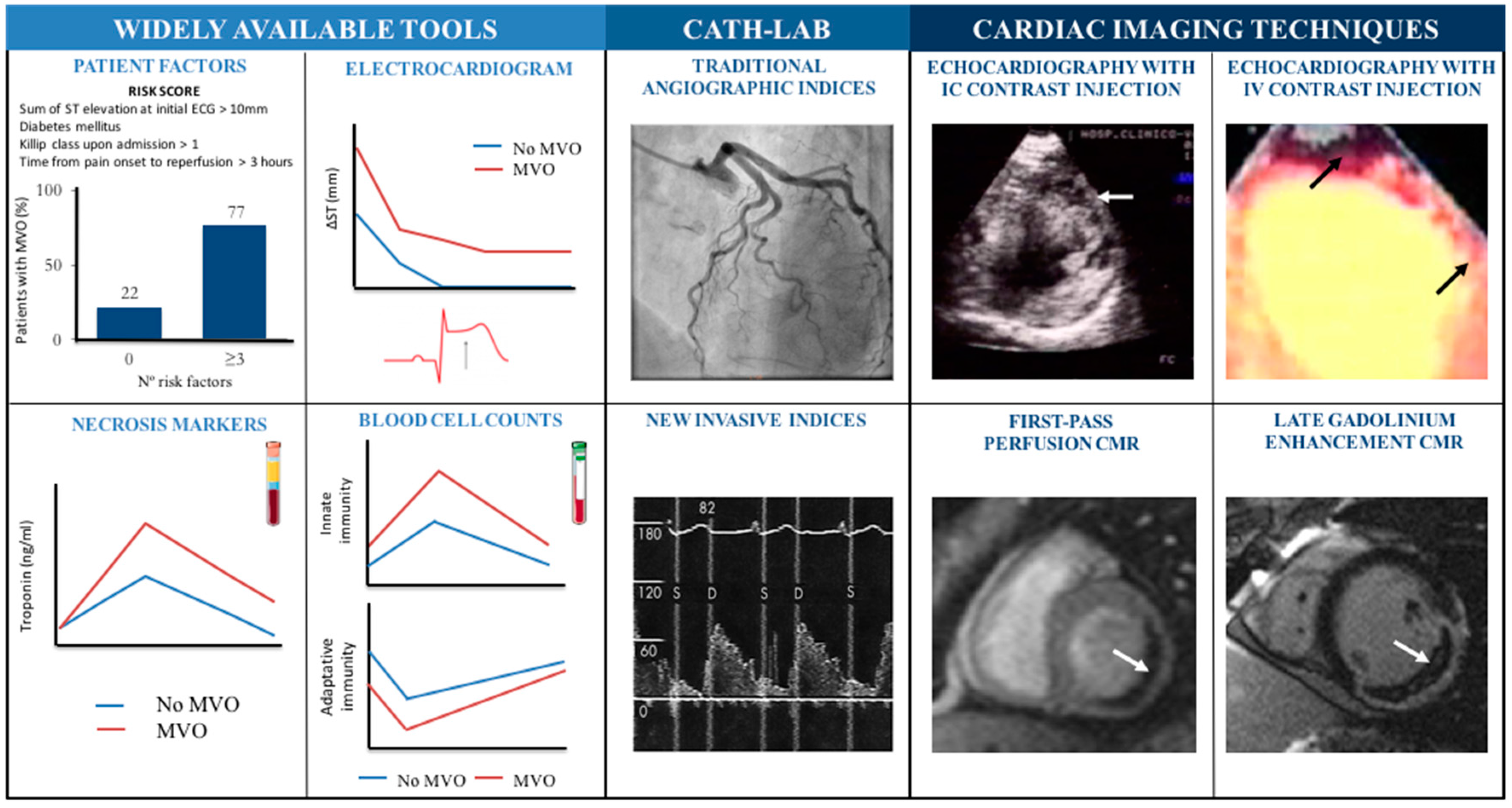 JCM Free FullText Microvascular Obstruction in STSegment Elevation Myocardial Infarction