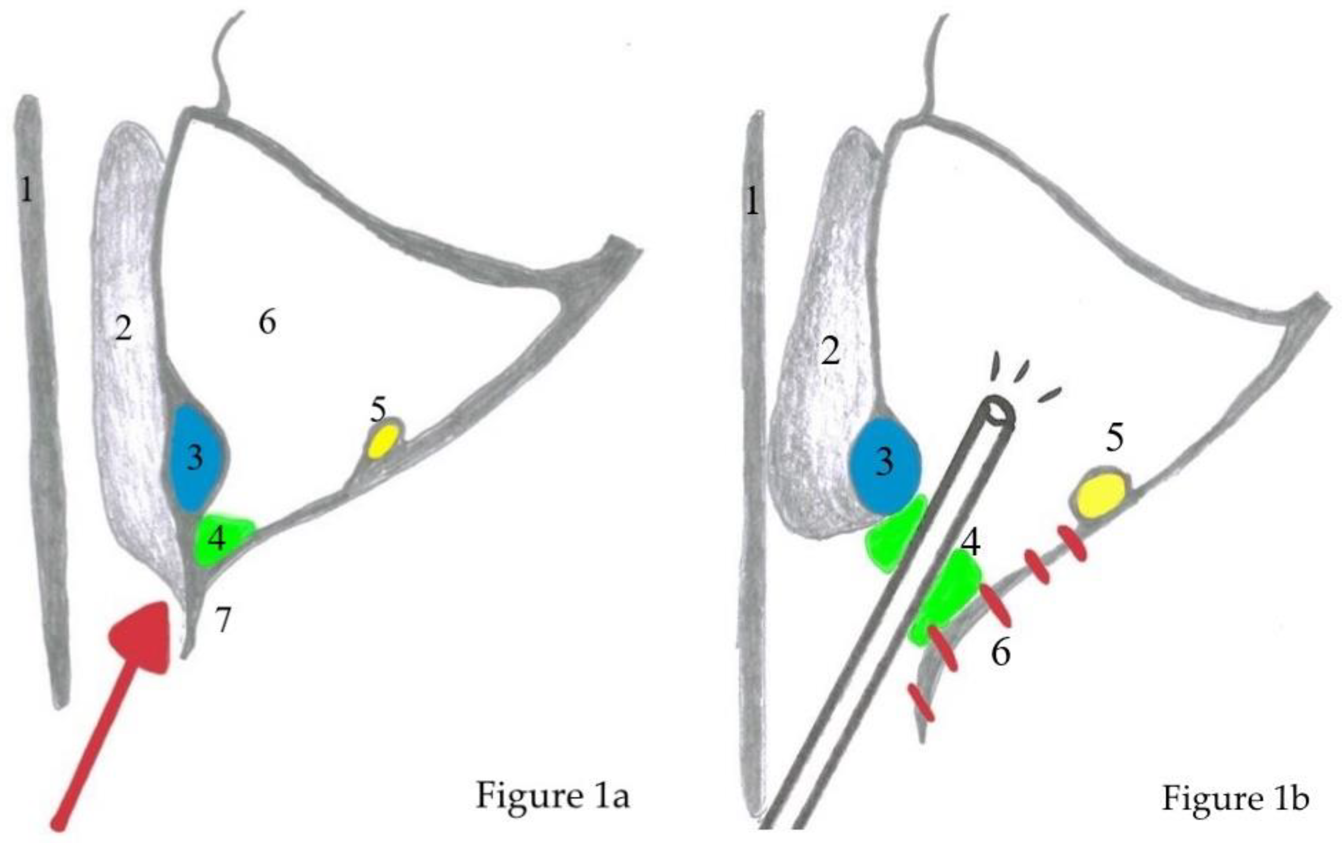 sinonasal inverted papilloma medial maxillectomy