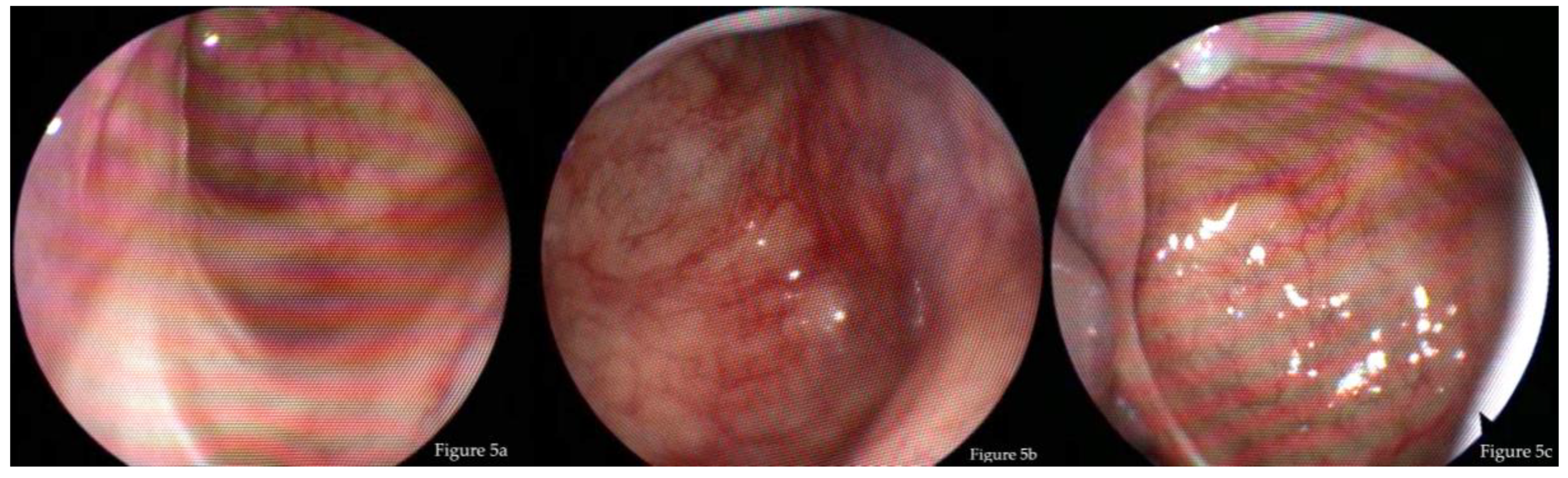 sinonasal inverted papilloma medial maxillectomy)