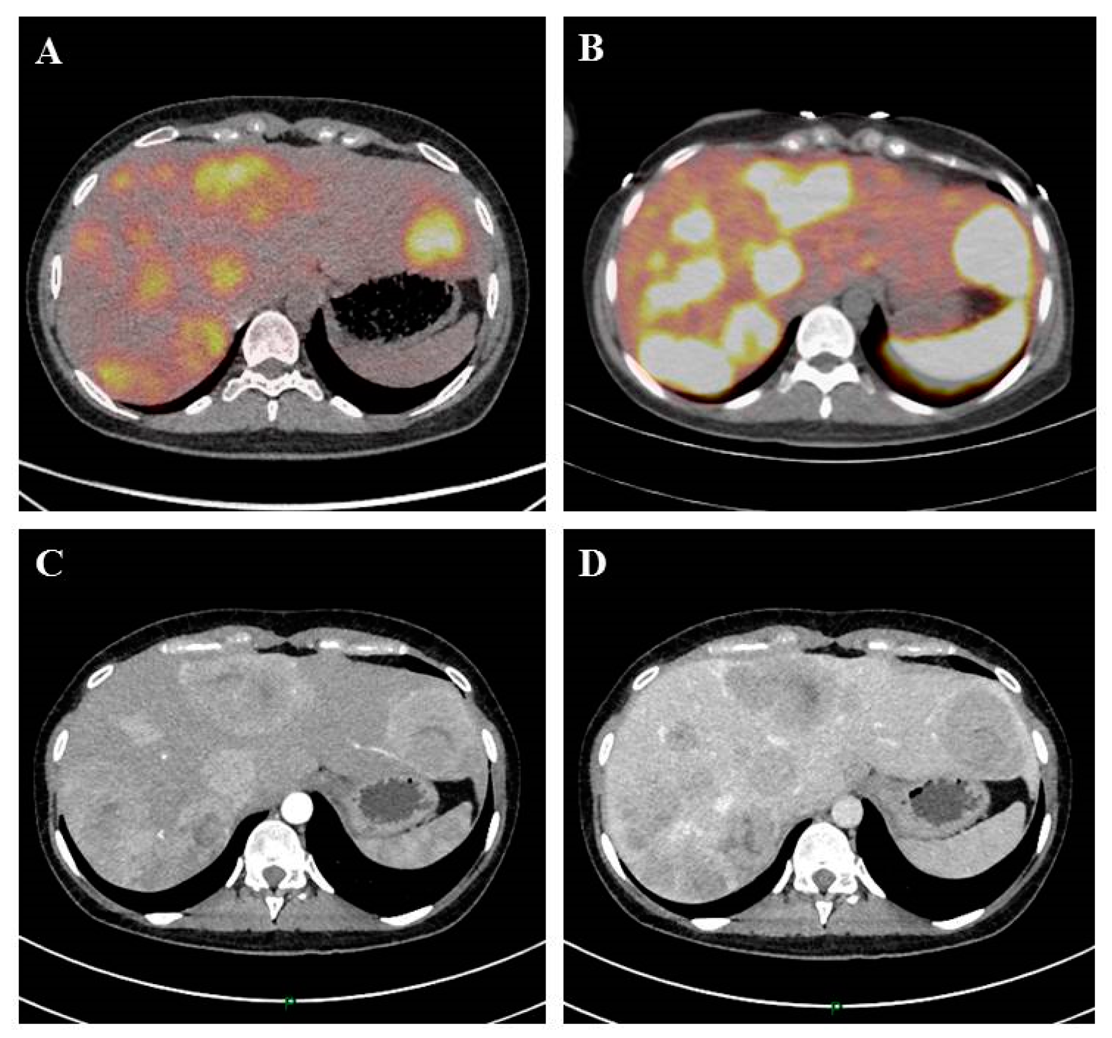 neuroendocrine cancer liver mets prognosis hpv treatment duration