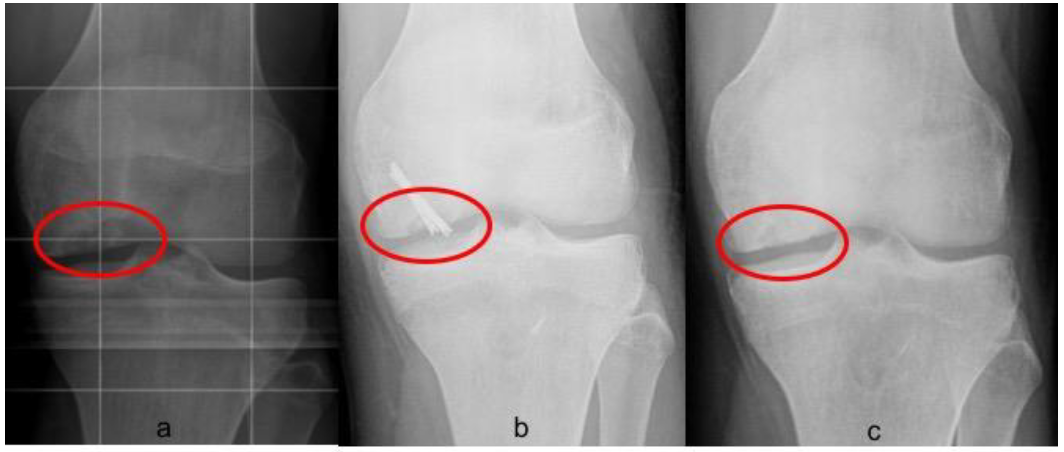 osteochondritis dissecans of the knee