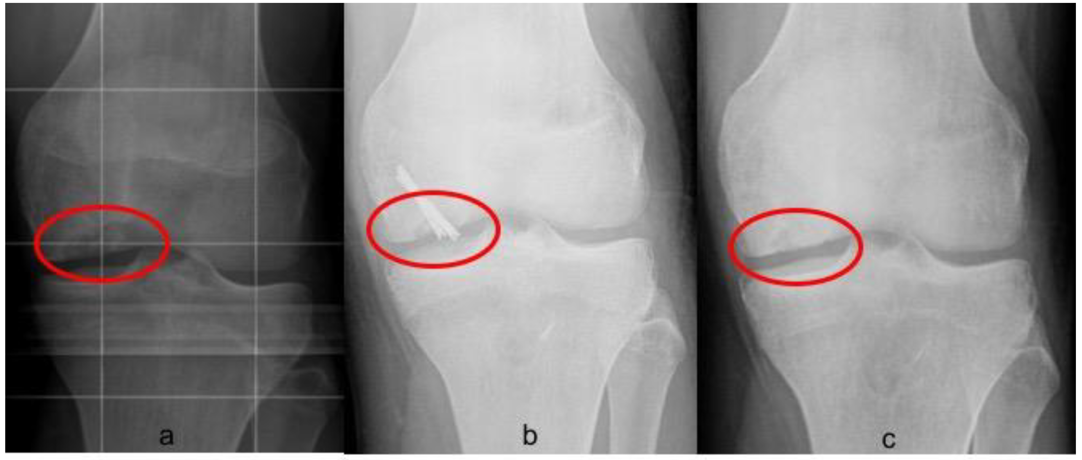 osteochondritis dissecans of the knee)