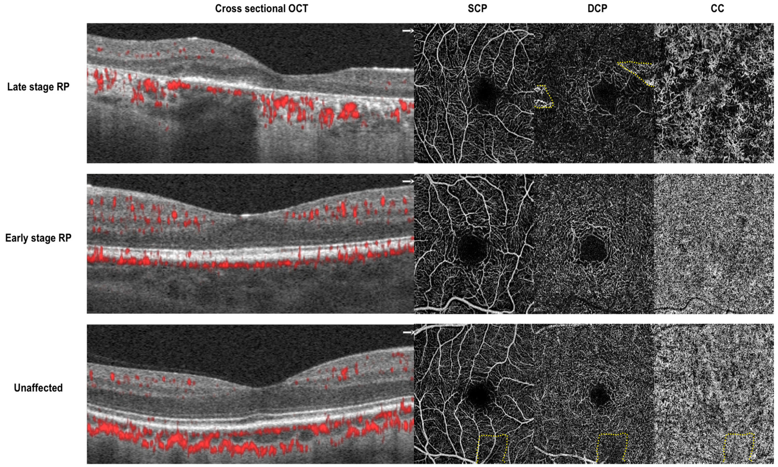 Jcm Free Full Text Optical Coherence Tomography Angiography Imaging In Inherited Retinal Diseases Html