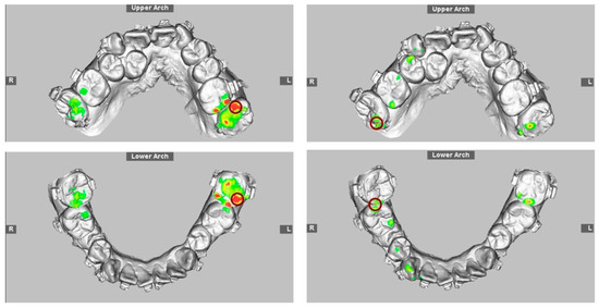 JCM | Free Full-Text | Modern Surgery-First Approach Concept in Cleft-Orthognathic Surgery: A Comparative Cohort Study with 3D Quantitative Analysis of Surgical-Occlusion Setup JCM | Free Full-Text | Modern Surgery-First Approach Concept in Cleft-Orthognathic Surgery: A Comparative Cohort Study with 3D Quantitative Analysis of Surgical-Occlusion Setup