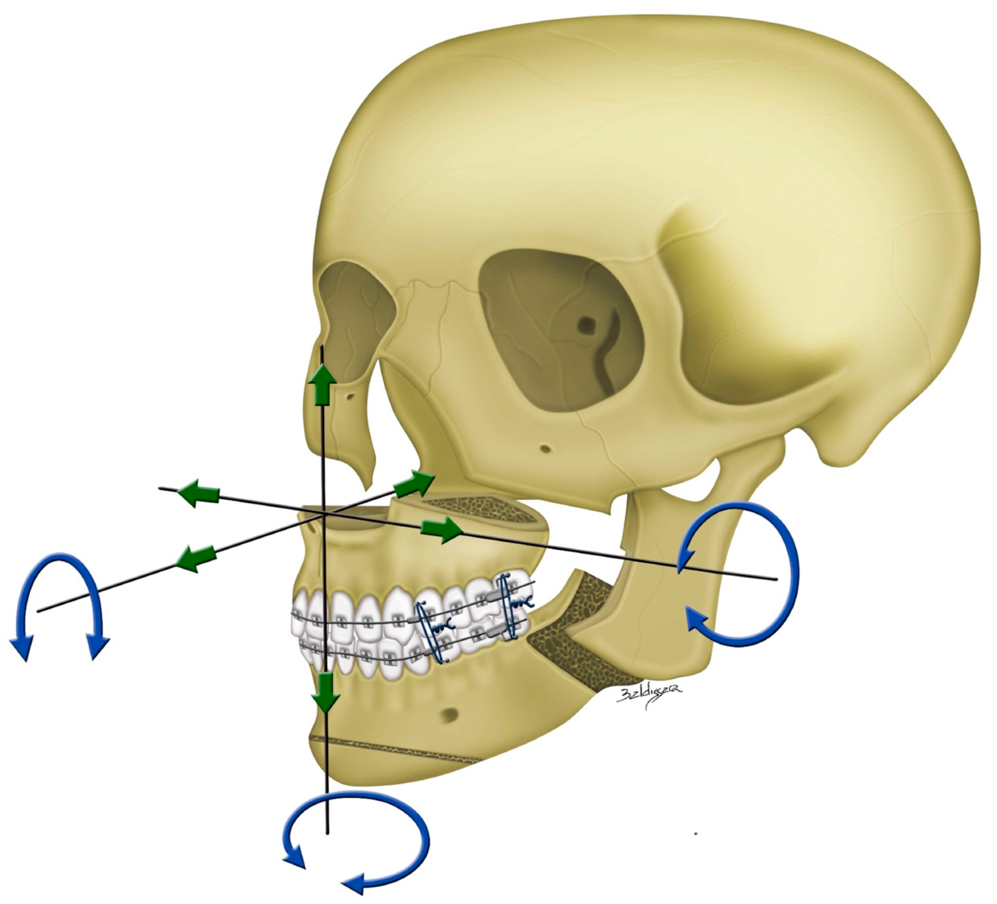 JCM | Free Full-Text | Modern Surgery-First Approach Concept in  Cleft-Orthognathic Surgery: A Comparative Cohort Study with 3D Quantitative  Analysis of Surgical-Occlusion Setup
