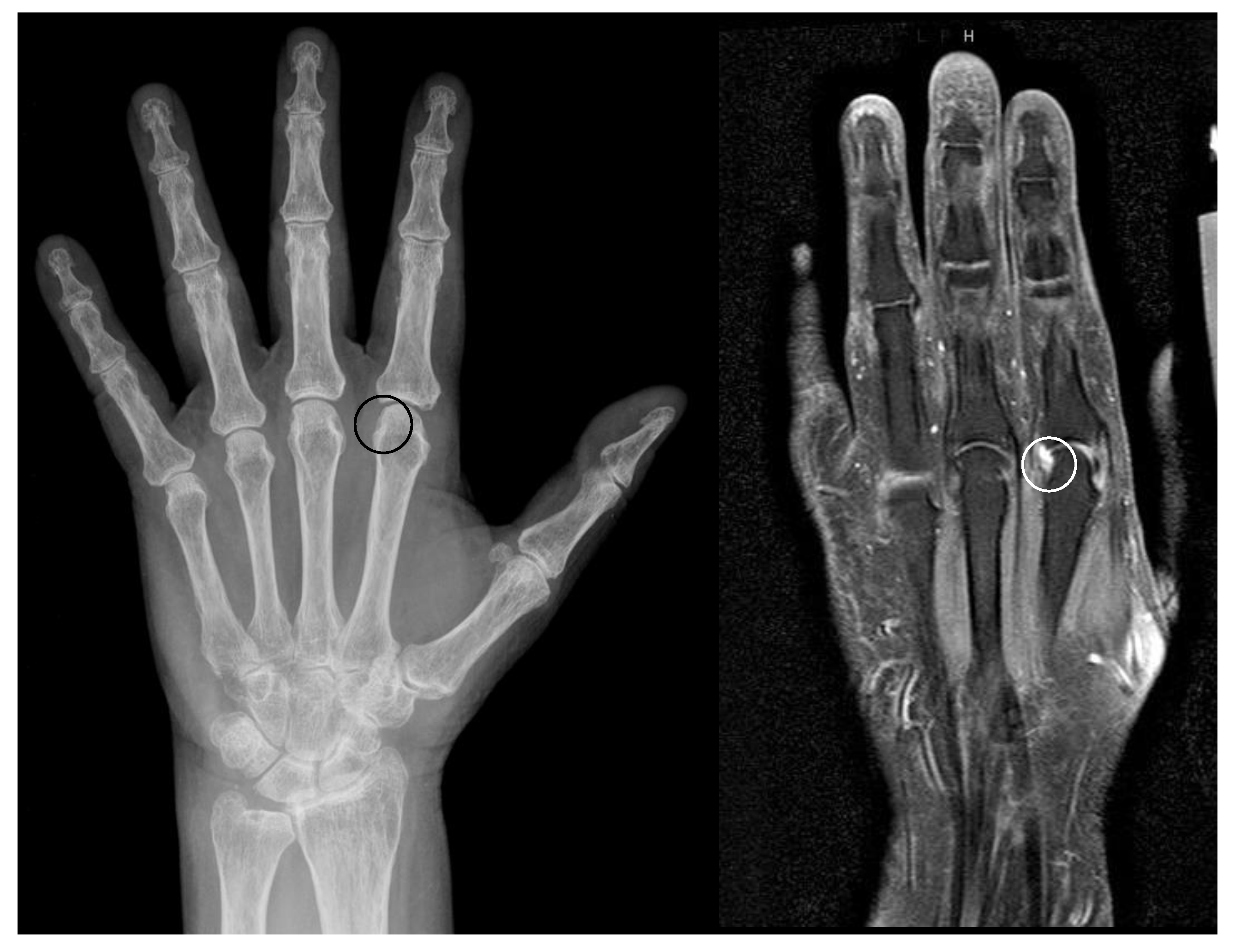 osteoarthritis radiology wrist)