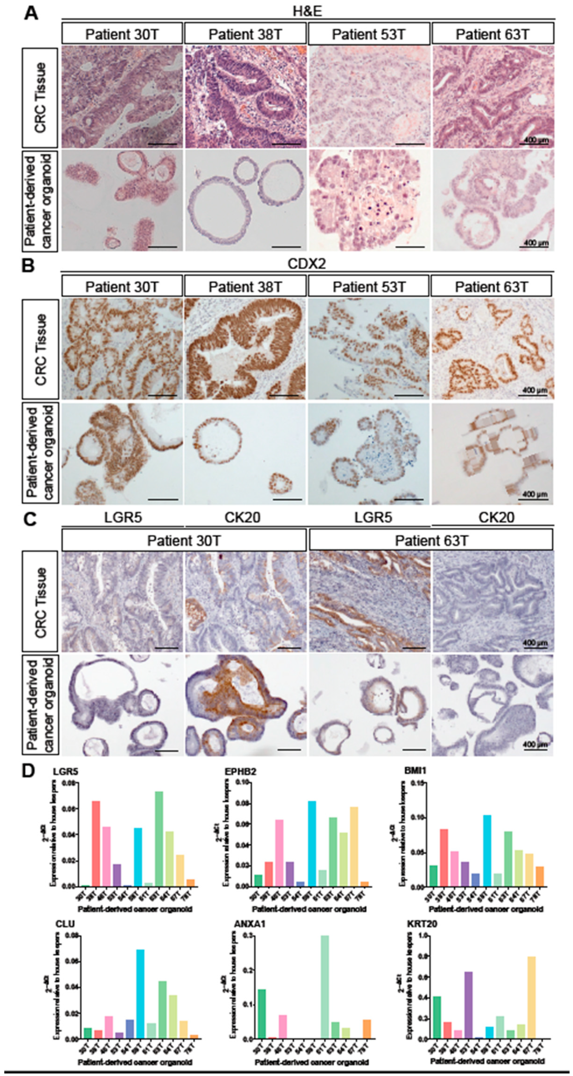 Organoid Culture of Isolated Cells from Patient-derived Tissues with Colorectal Cancer.