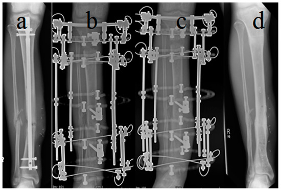 The outcomes of Ilizarov treatment in aseptic nonunions of the tibia  stratified by treatment strategies and surgical techniques