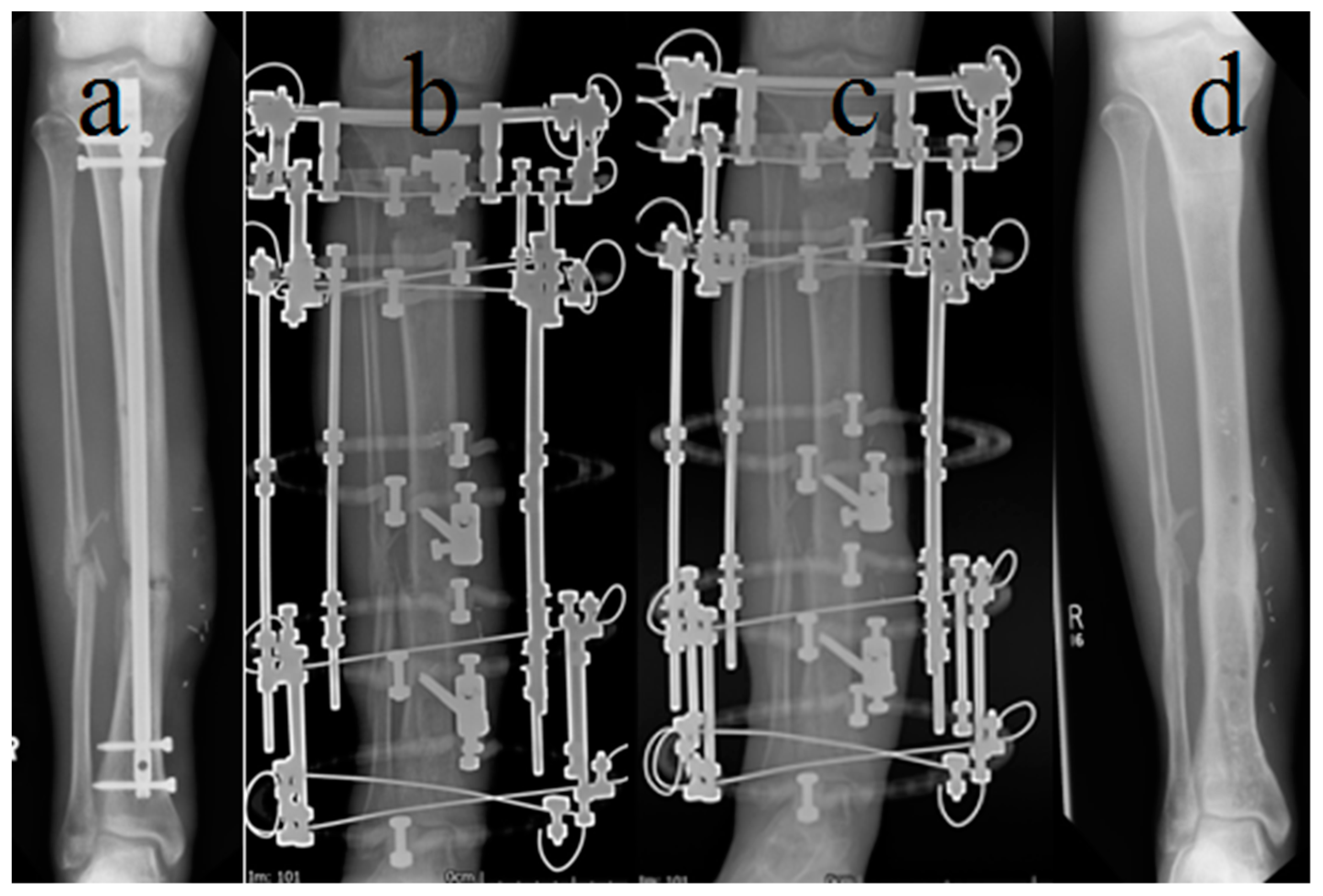 Double-level, proximal-to-distal bone transport using wire fixation. A