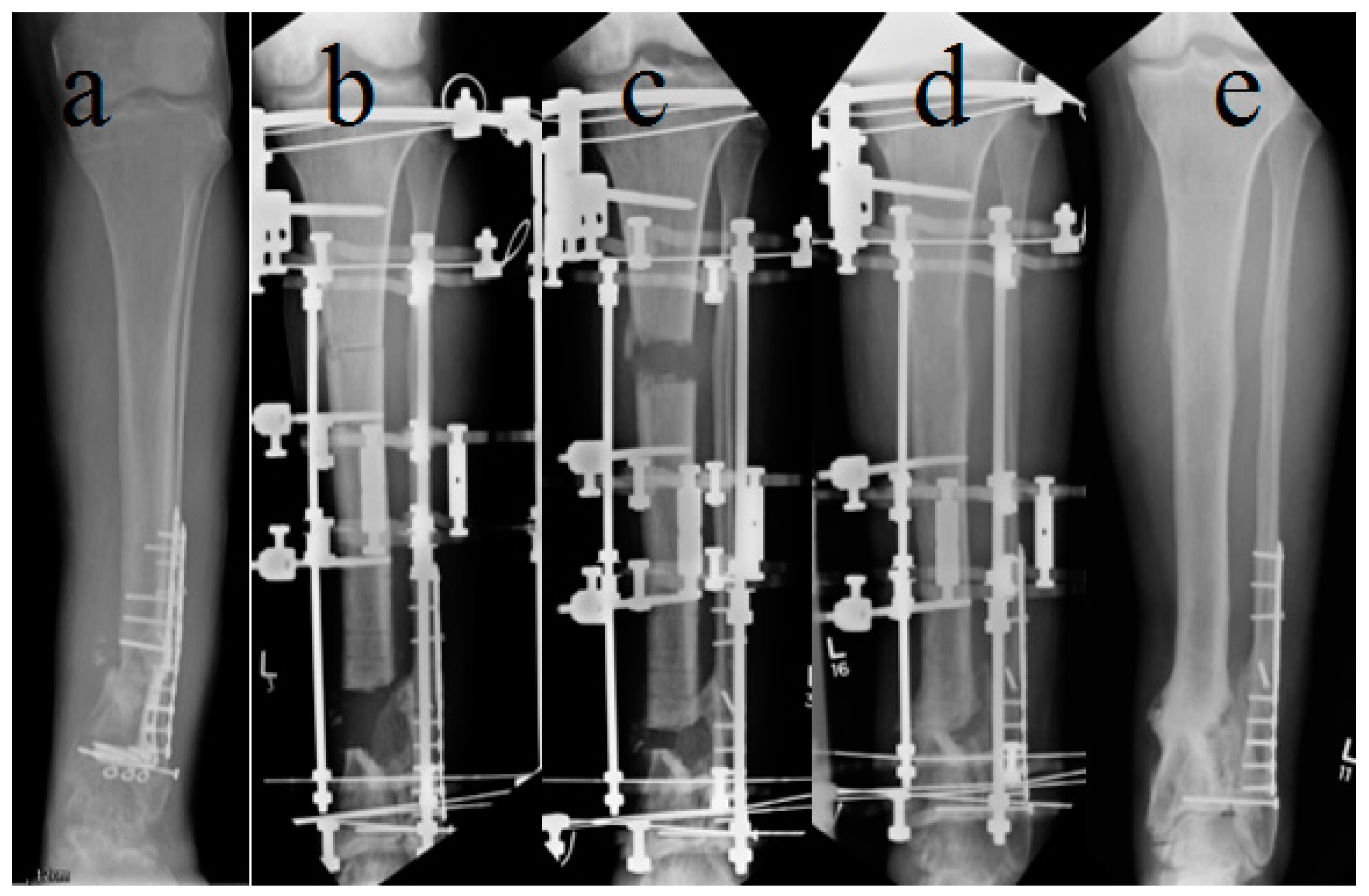 The outcomes of Ilizarov treatment in aseptic nonunions of the tibia  stratified by treatment strategies and surgical techniques