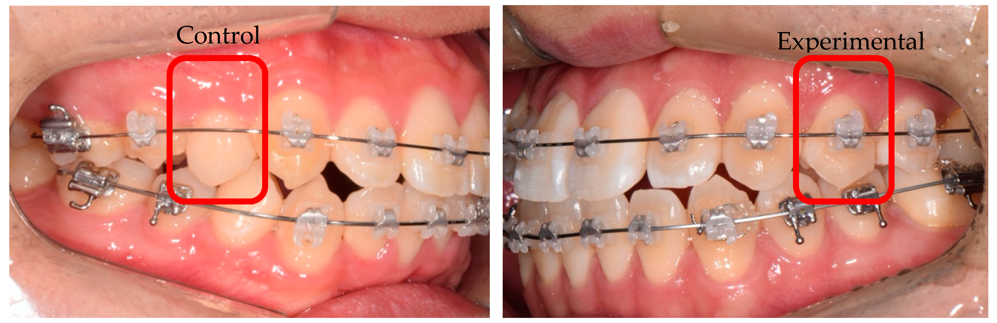 What does a reverse curve wire do for braces? Tooth Time Family