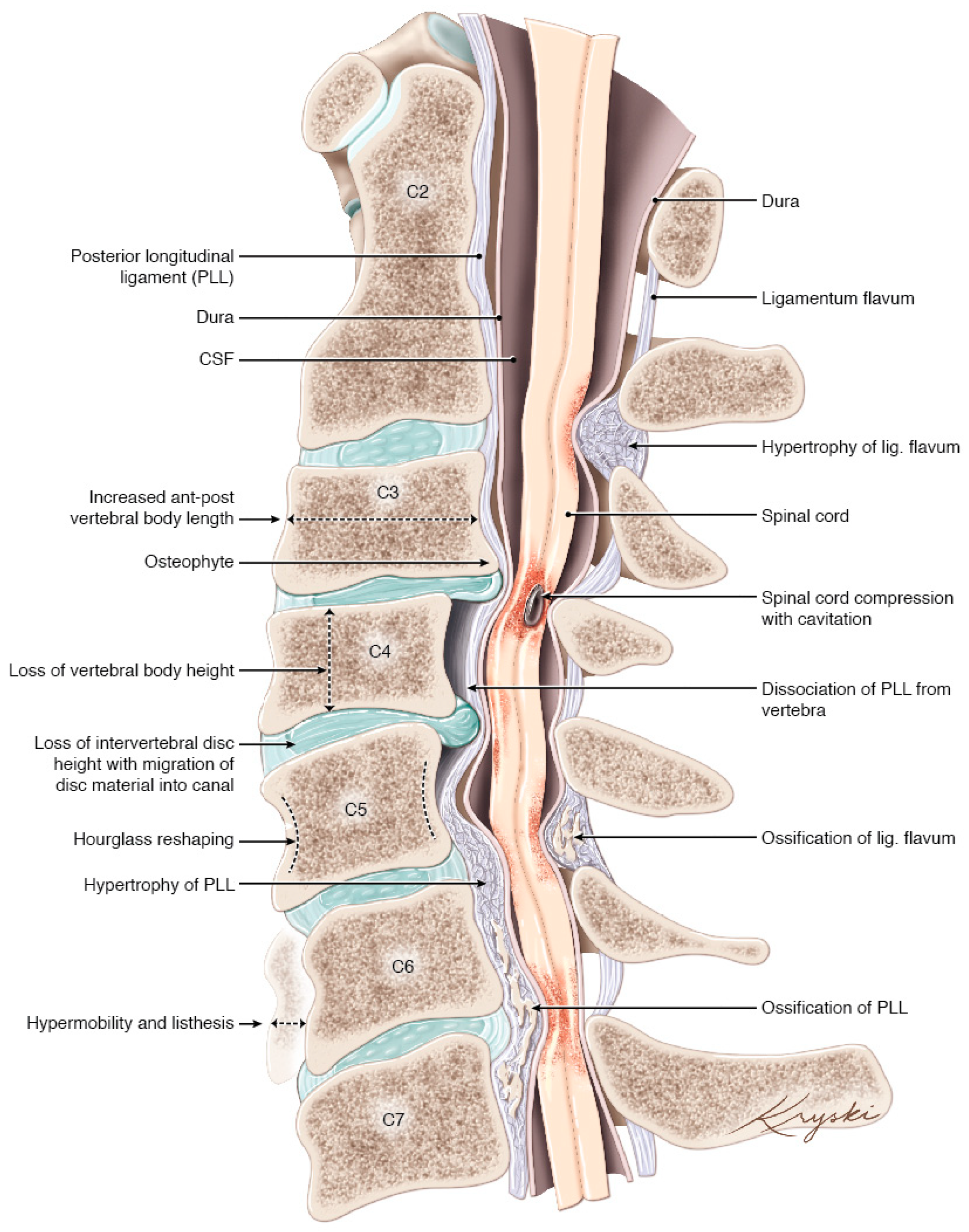 LATEST ADVANCES IN THE TREATMENT OF CERVICAL SPINE DEGENERATION