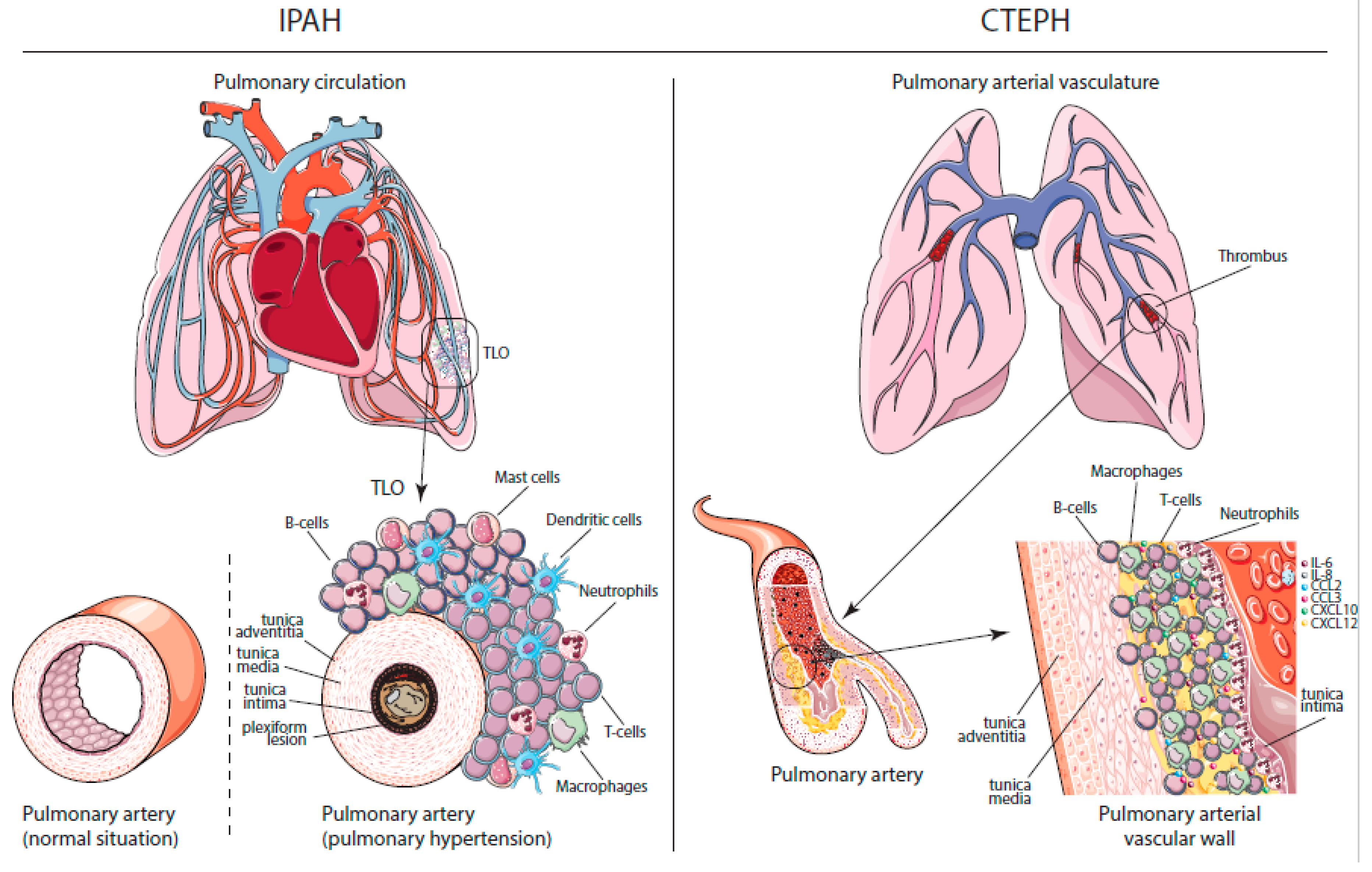 pulmonary artery hypertension