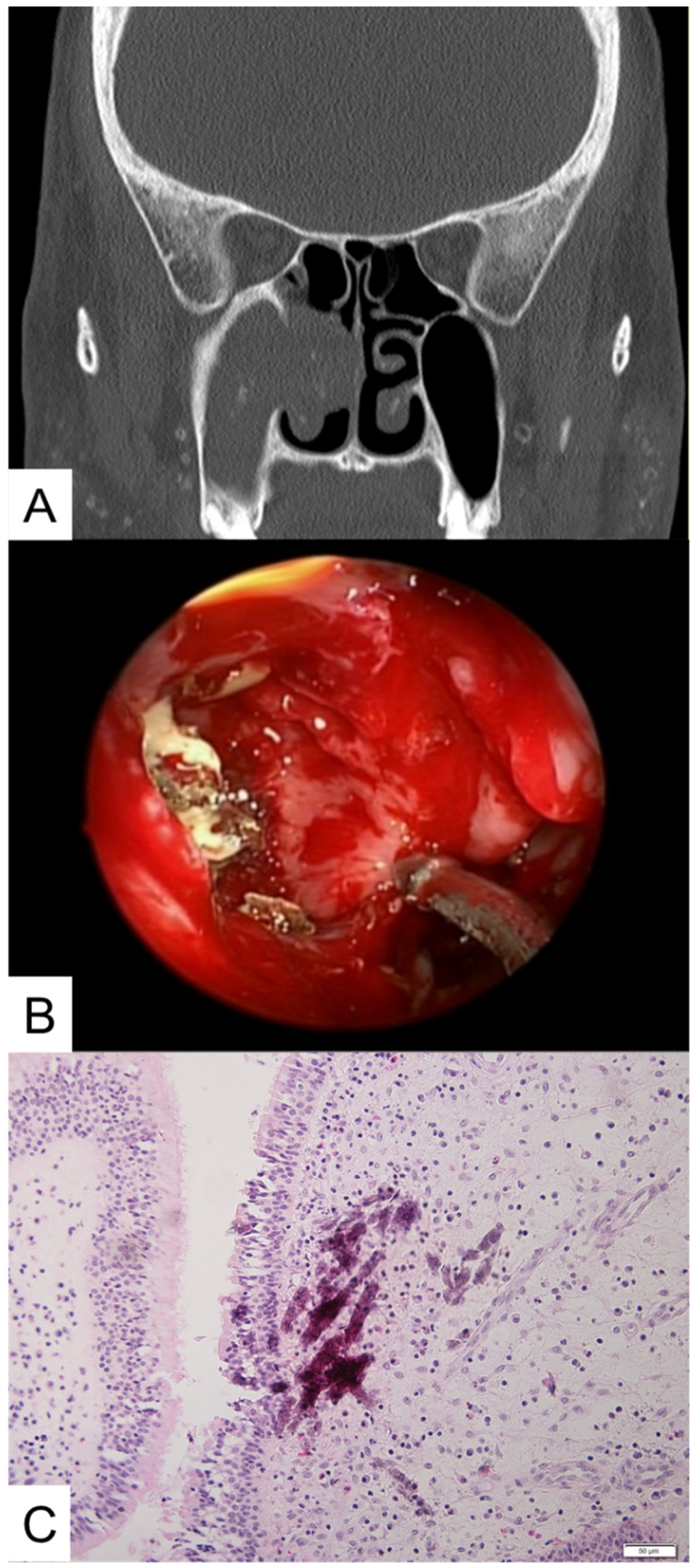 JCM Free Full Text Microinvasive Fungal Rhinosinusitis