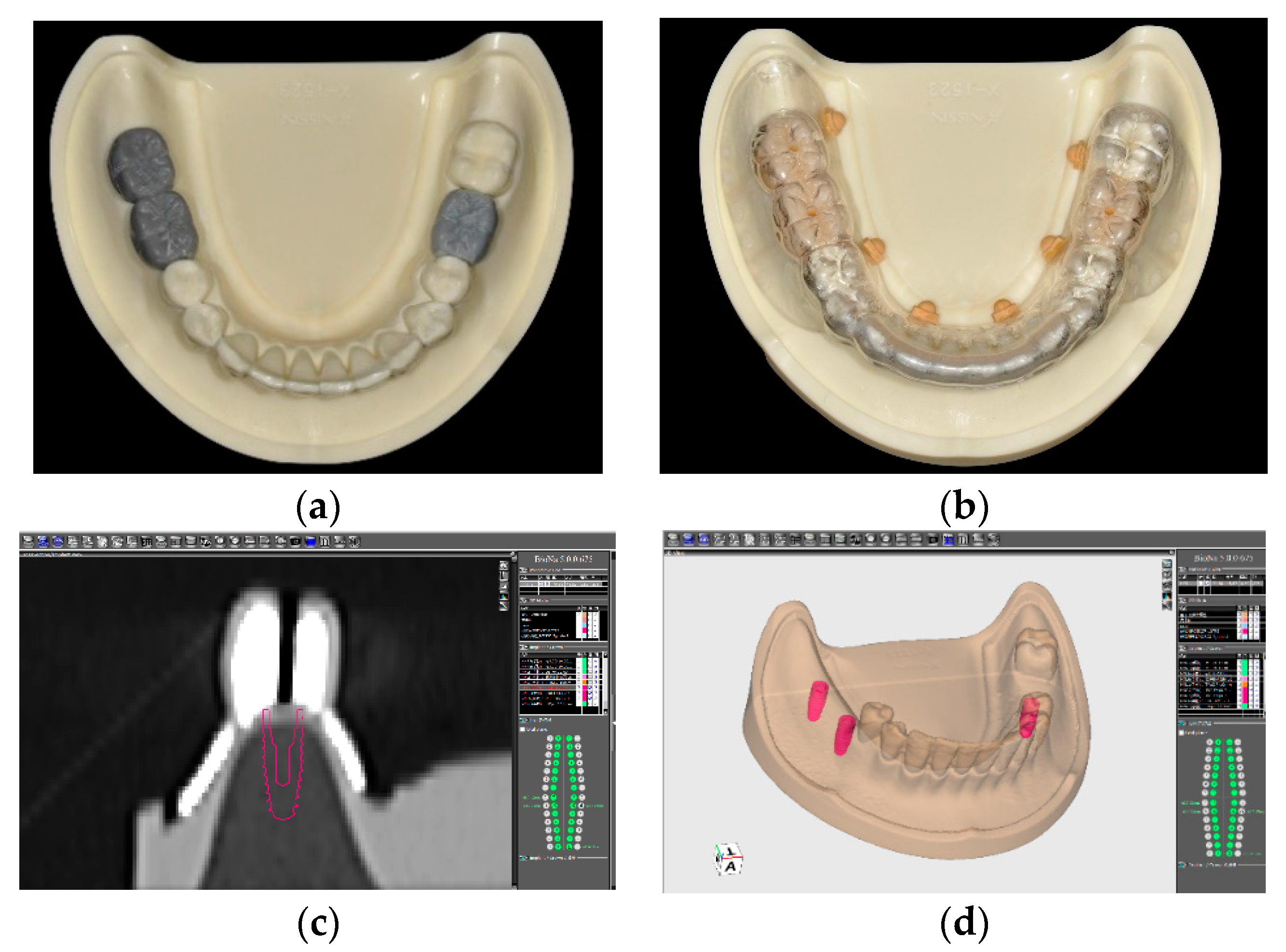 JCM Free FullText Stereolithographic Surgical Guide with a
