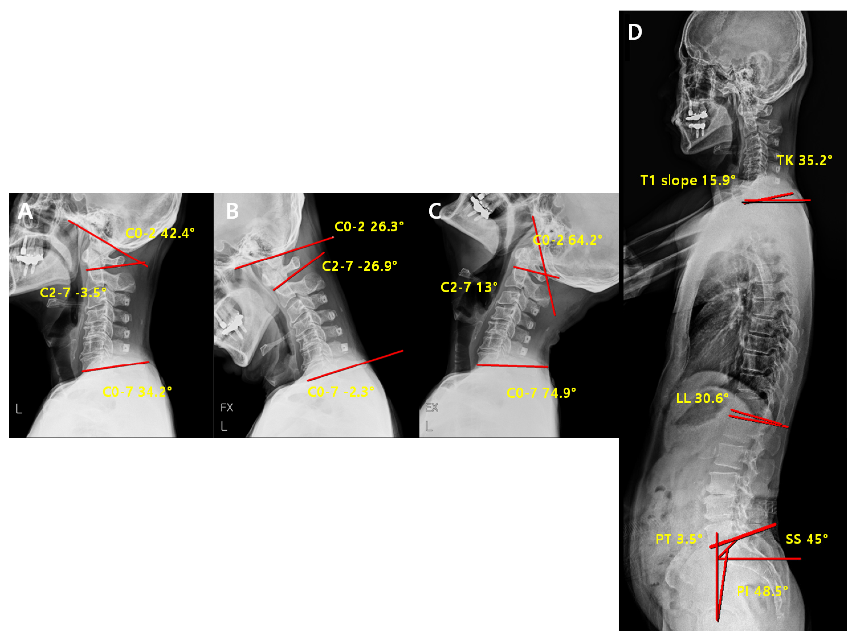 JCM | Free Full-Text | Analysis of Cervical Spine Alignment and its