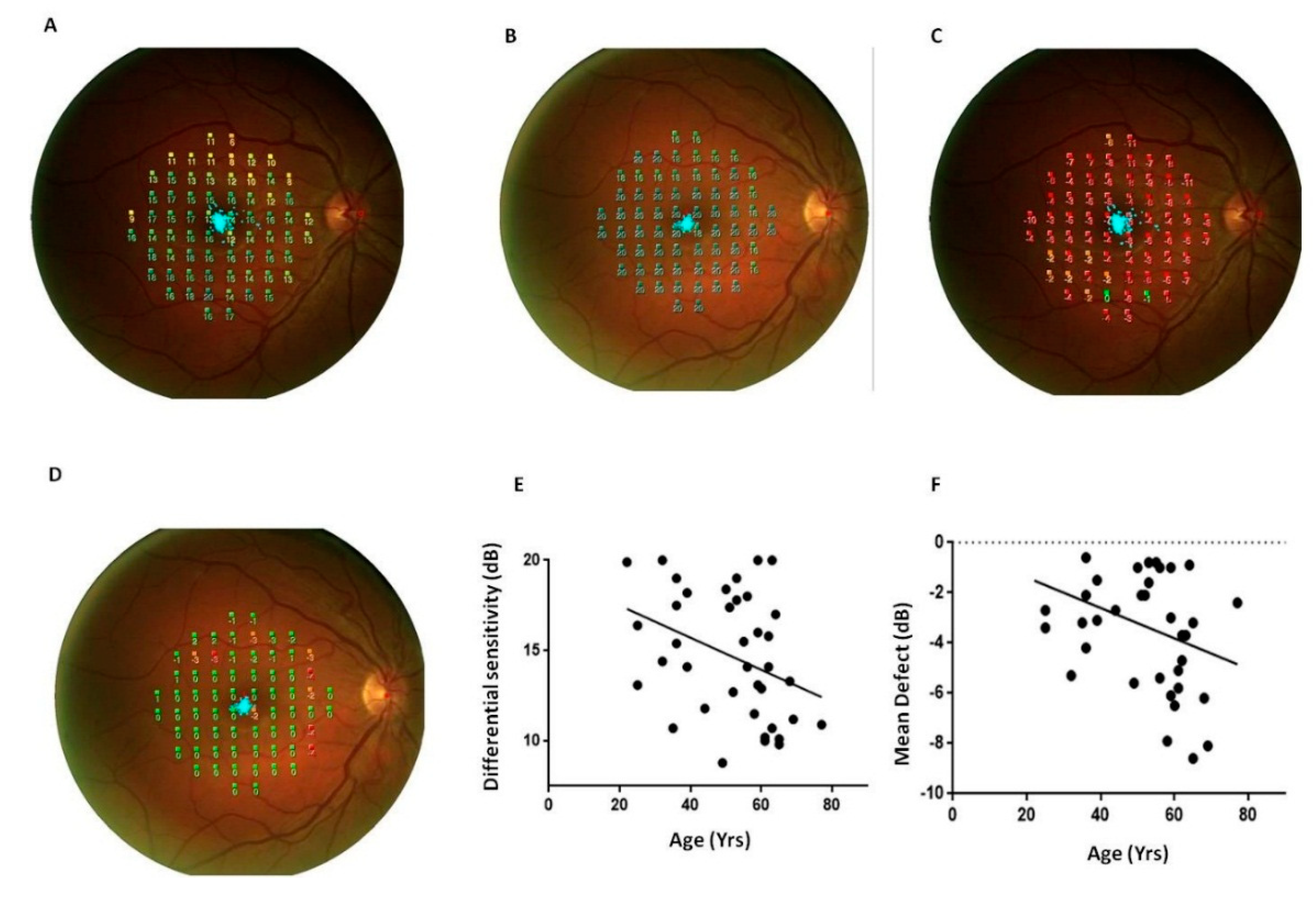 Retinal vascular assessment in psoriatic patients with and without  metabolic syndrome using optical coherence tomography angiography