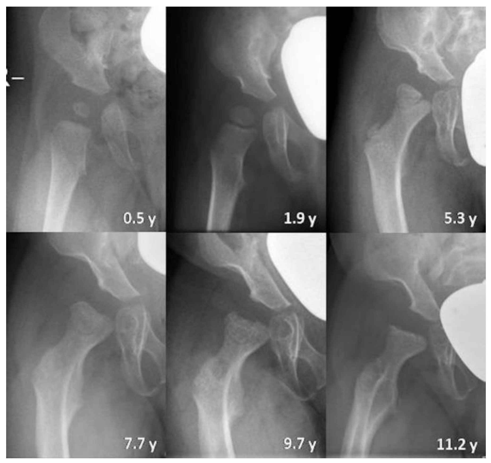 Jcm Free Full Text Hip Morphology In Mucolipidosis Type Ii Html