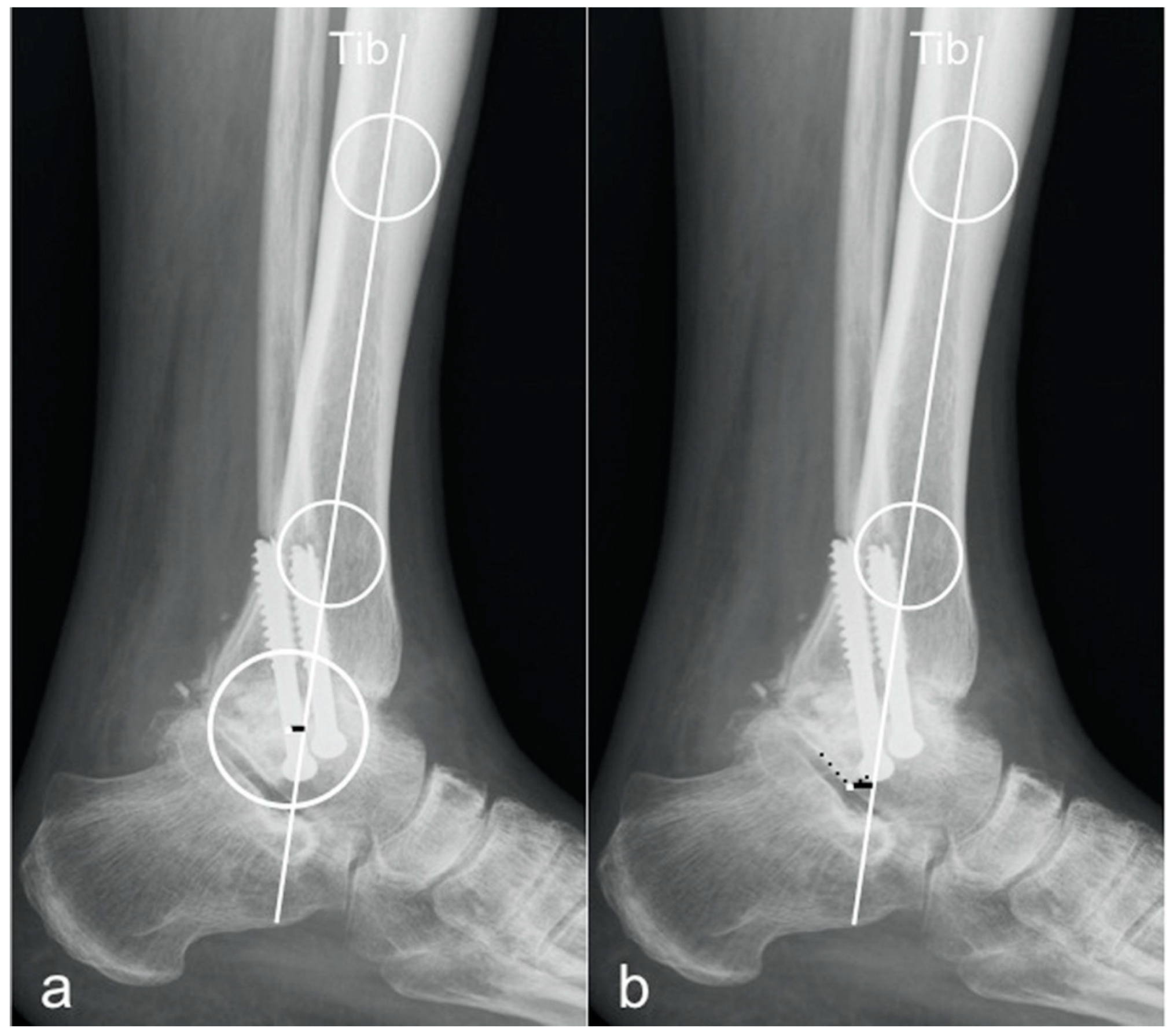 Use of a modified retrograde femoral rod as a custom length  tibiotalocalcaneal nail. - Abstract - Europe PMC