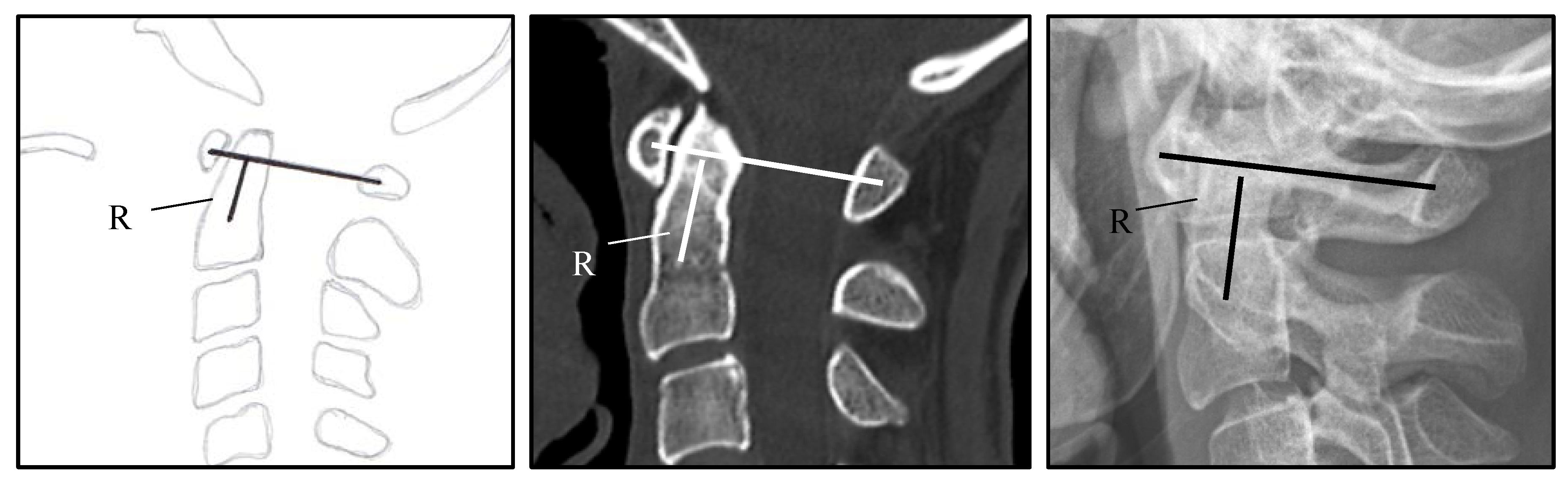 Jcm Free Full Text Cervical Myelopathy In Patients Suffering From Rheumatoid Arthritis A Case Series Of 9 Patients And A Review Of The Literature Html