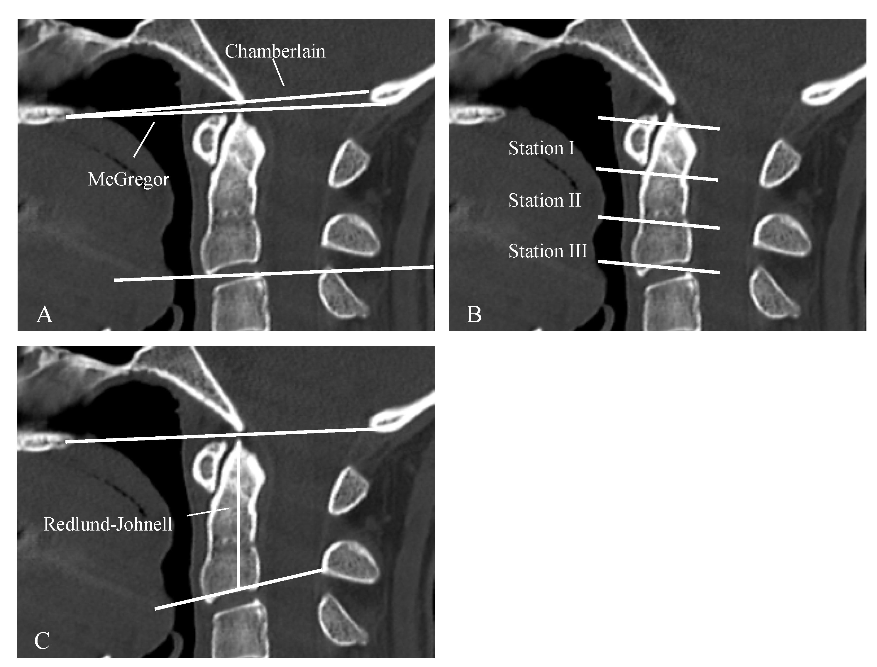 Jcm Free Full Text Cervical Myelopathy In Patients Suffering From Rheumatoid Arthritis A Case Series Of 9 Patients And A Review Of The Literature Html