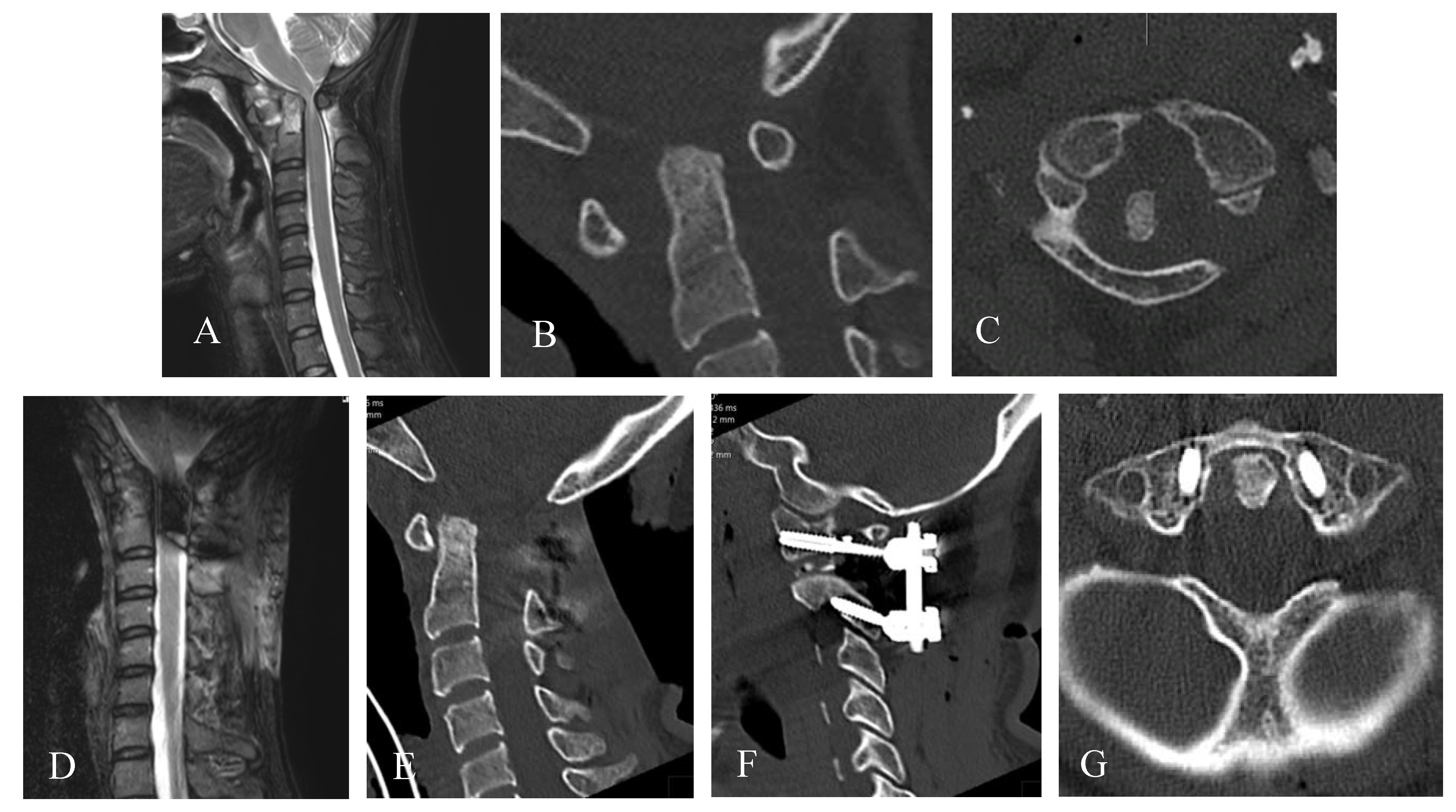 Jcm Free Full Text Cervical Myelopathy In Patients Suffering From Rheumatoid Arthritis A Case Series Of 9 Patients And A Review Of The Literature Html