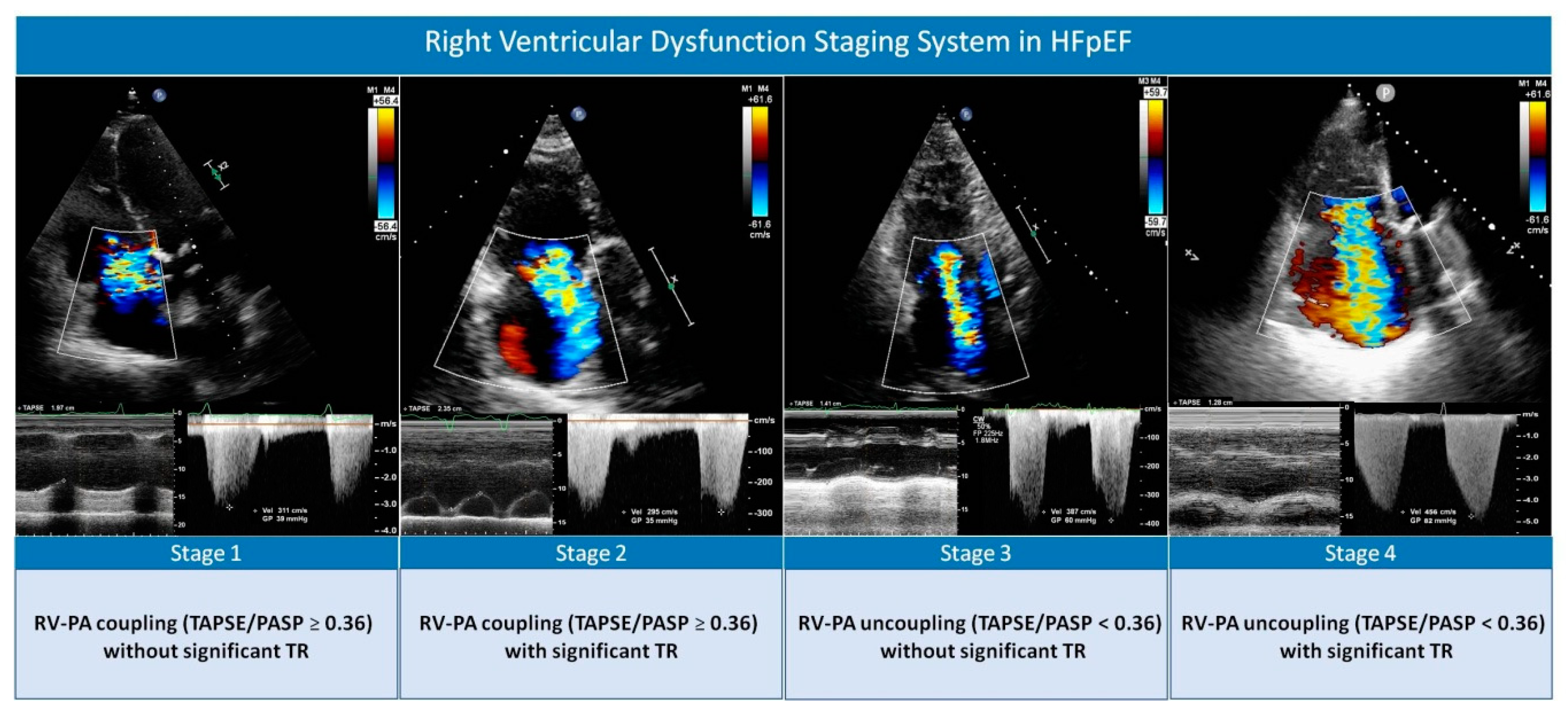 JCM Free FullText Right Ventricular Dysfunction Staging System for