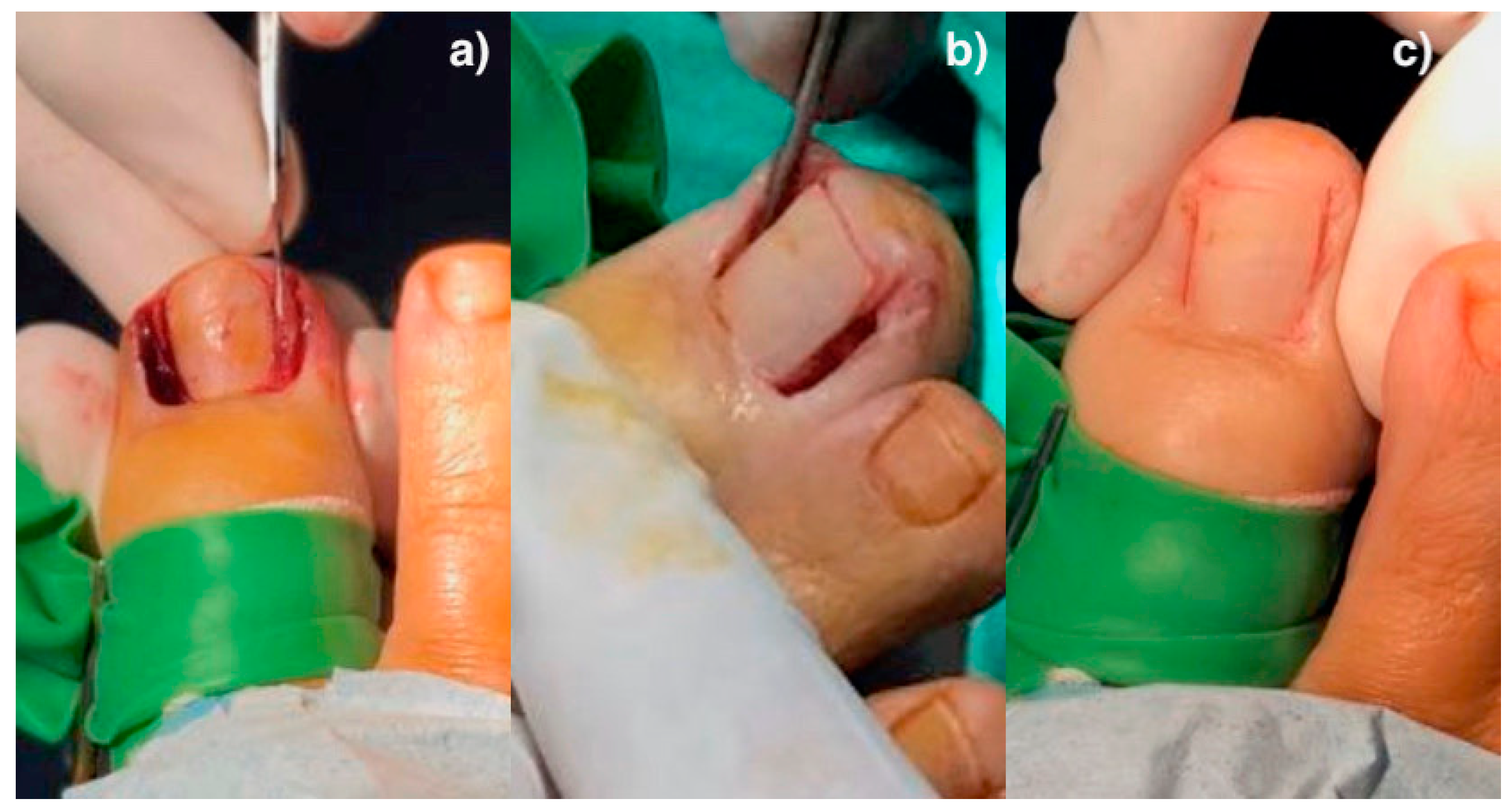 Ingrown Toe Nail Surgery - Aura Plastic Surgery