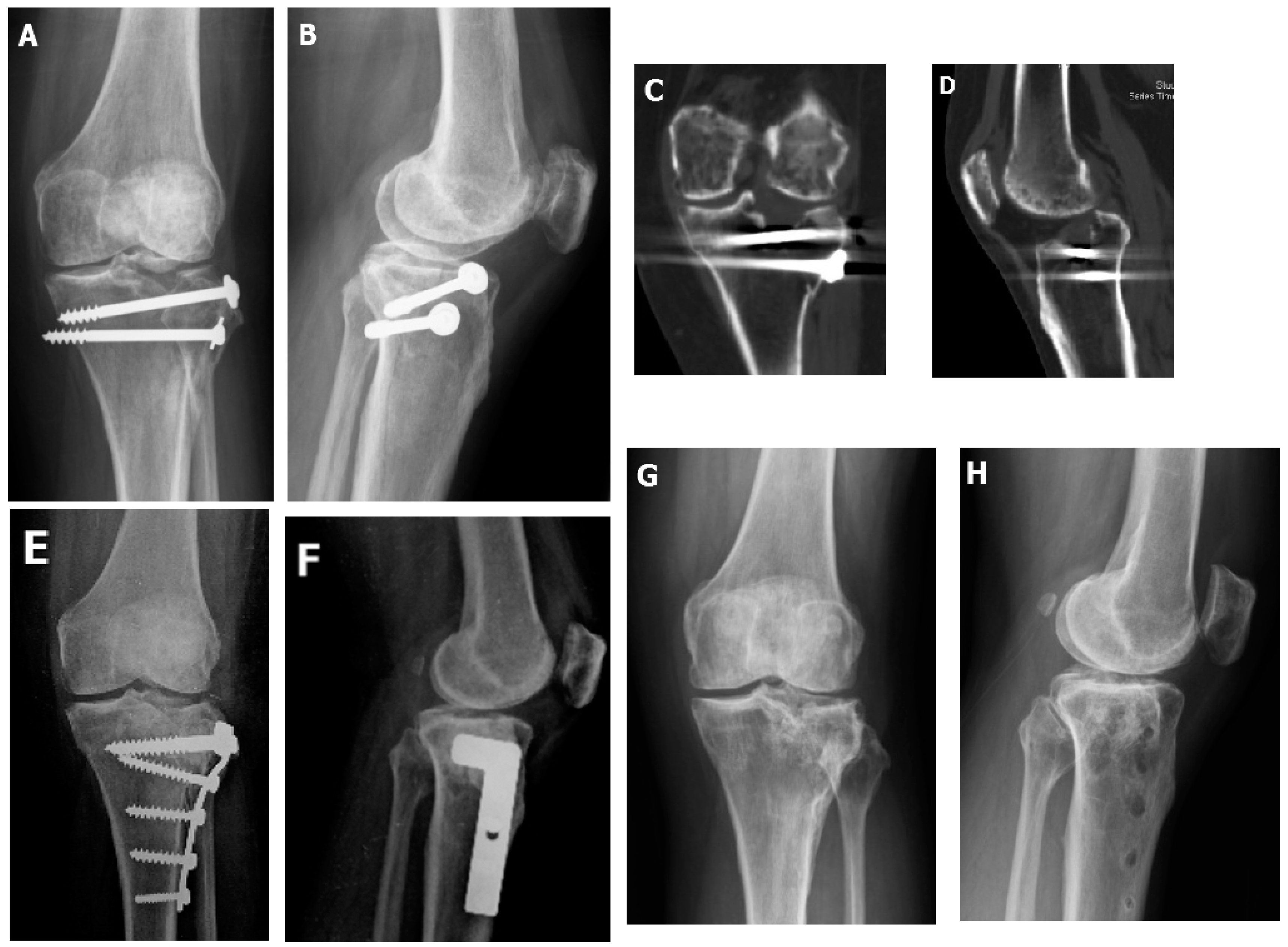 JCM Free FullText ArthroscopyAssisted Corrective Osteotomy