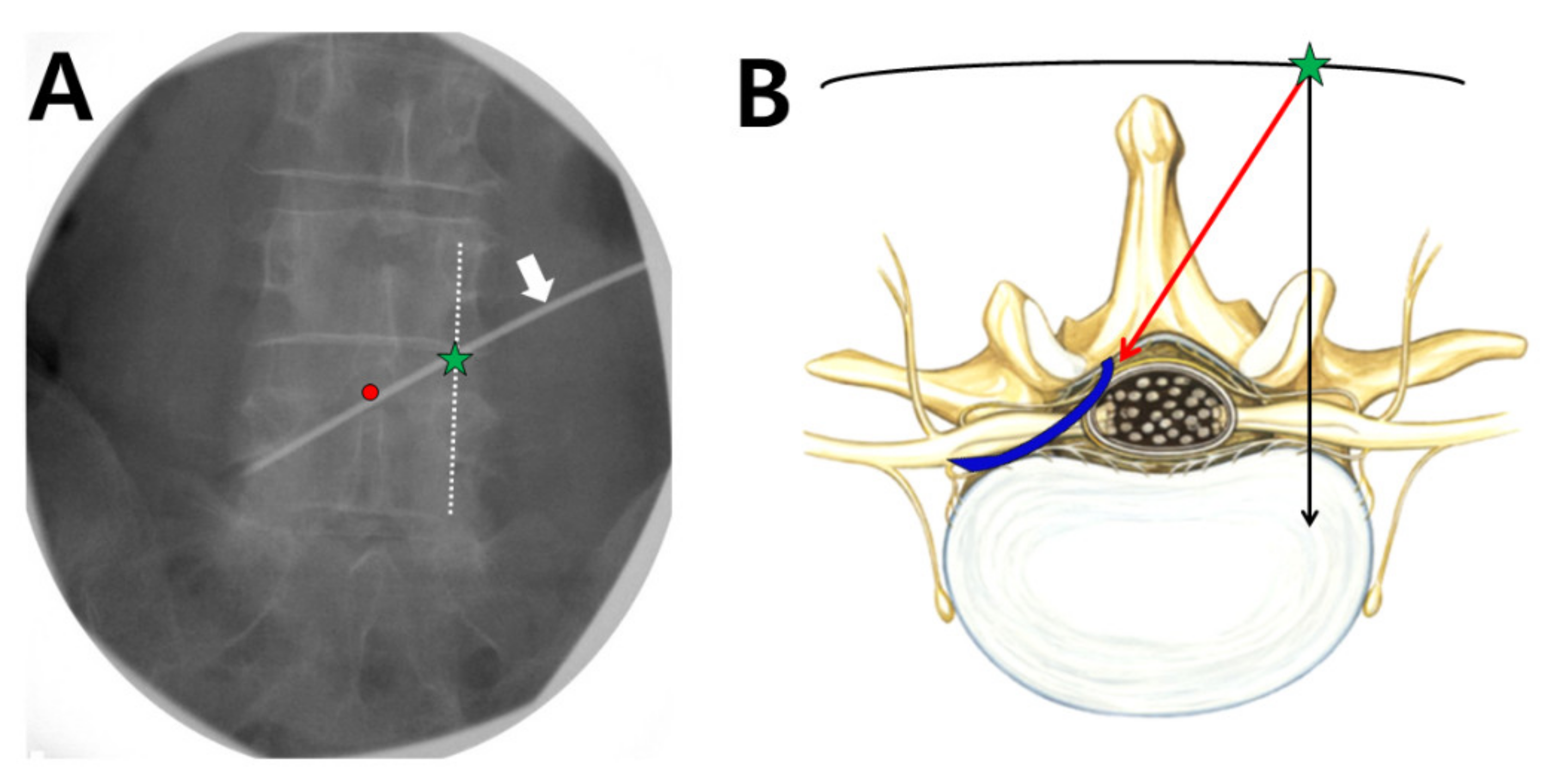 JCM Free FullText Transforaminal Epidural Balloon Adhesiolysis via