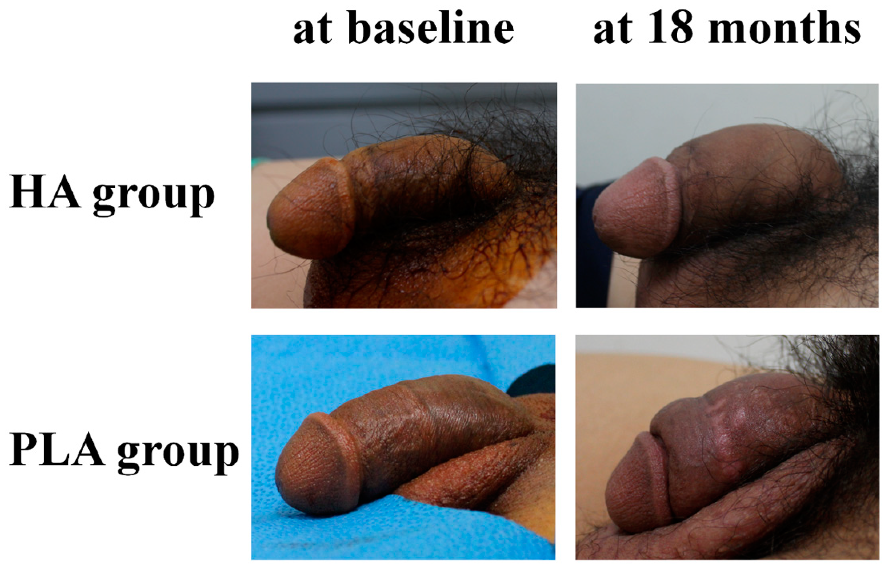 Figure 2.Representative photos of penis before and after hyaluronic acid an...