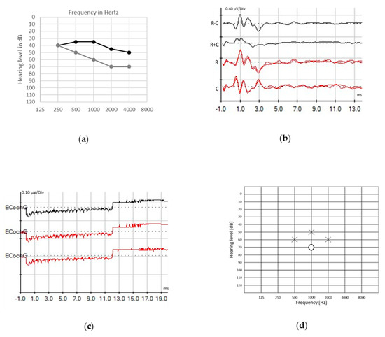 PDF) [Auditory steady-state response in the auditory evaluation: clinical  application]