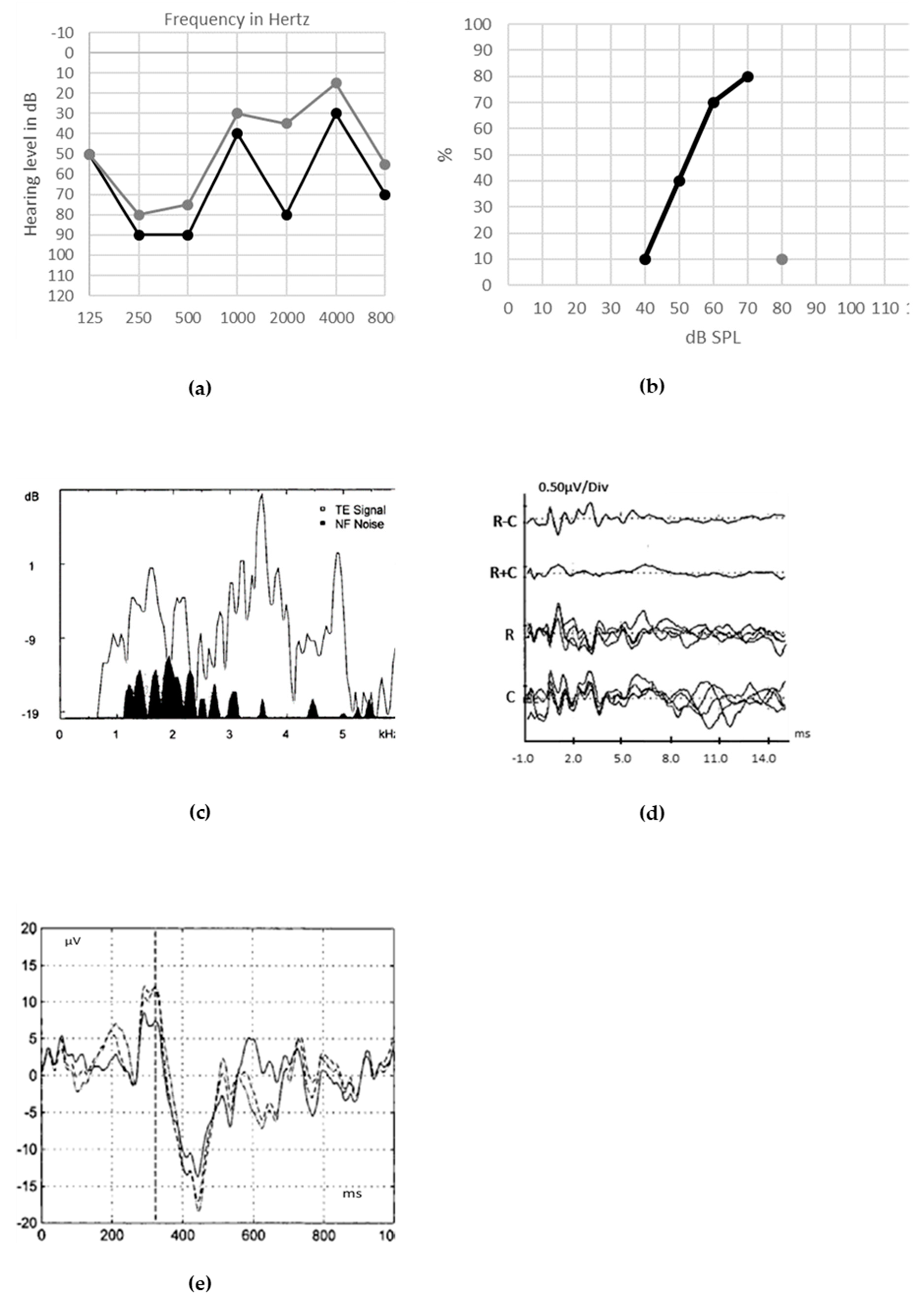 auditory neuropathy spectrum disorder auditory neuropathy spectrum disorder