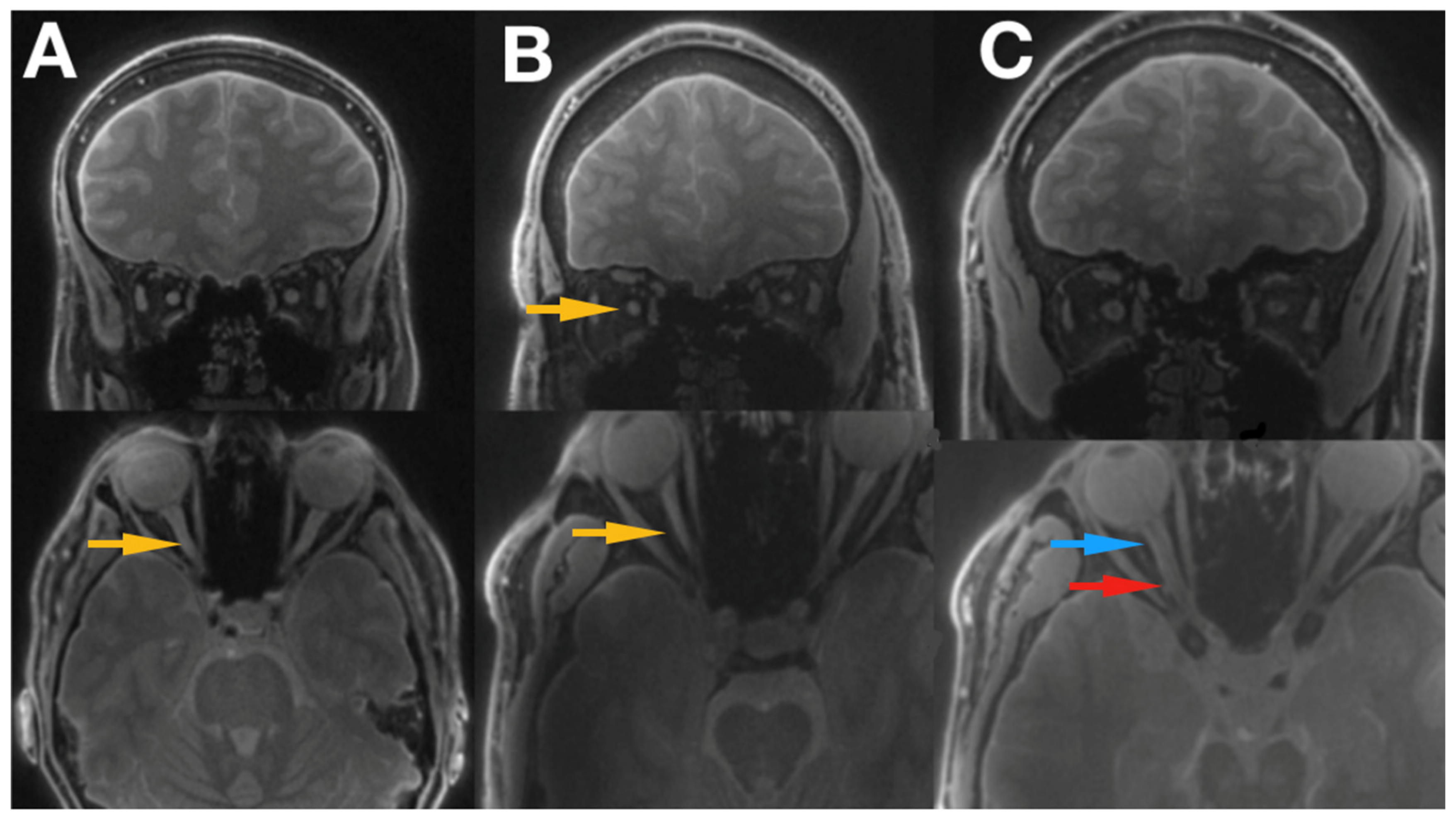 JCM Free FullText The Evaluation of Optic Nerves Using 7 Tesla