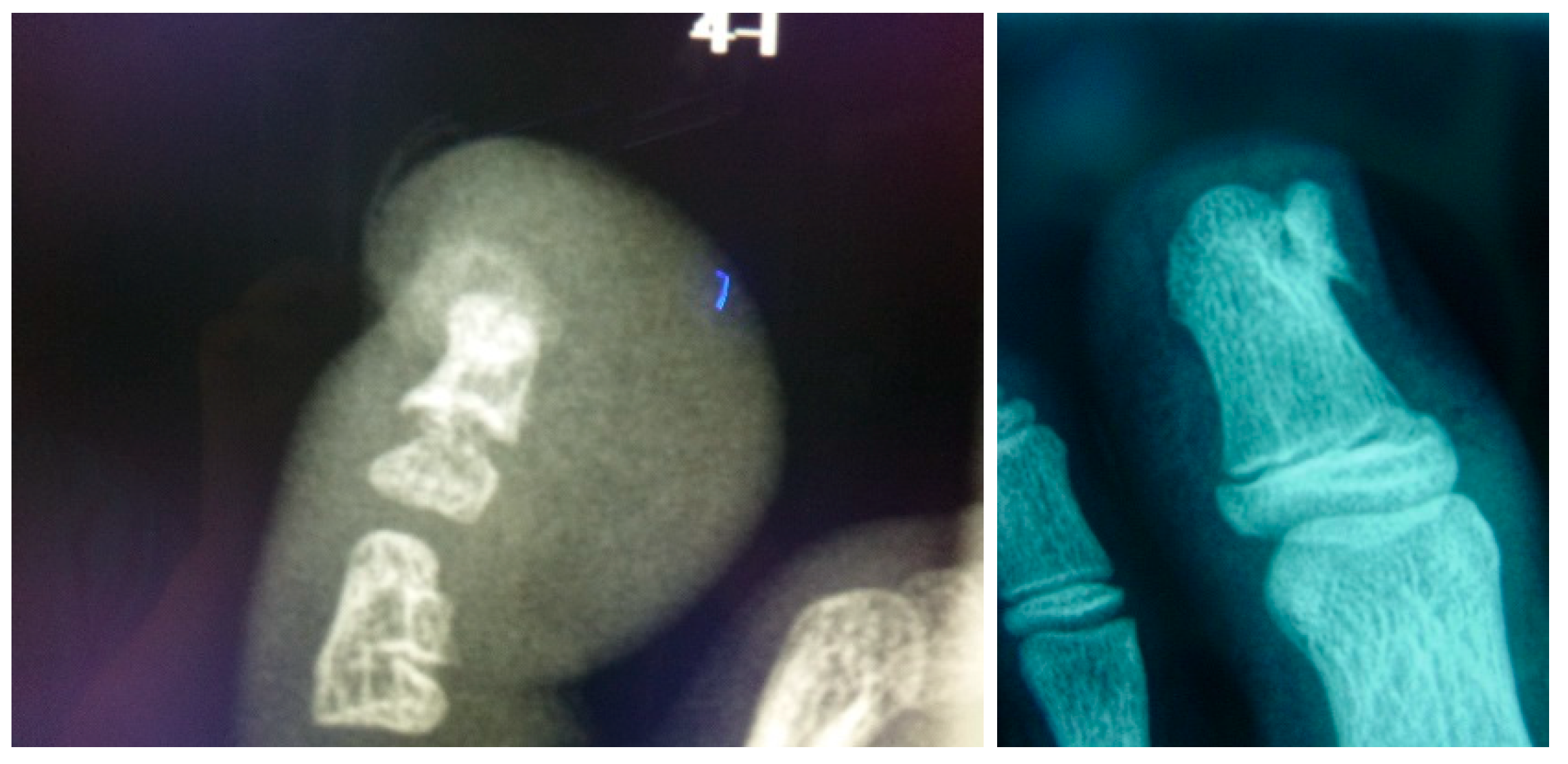 Jcm Free Full Text Surgical Treatment On Subungual Osteochondromas In Paediatric Feet A Case Series Study Html