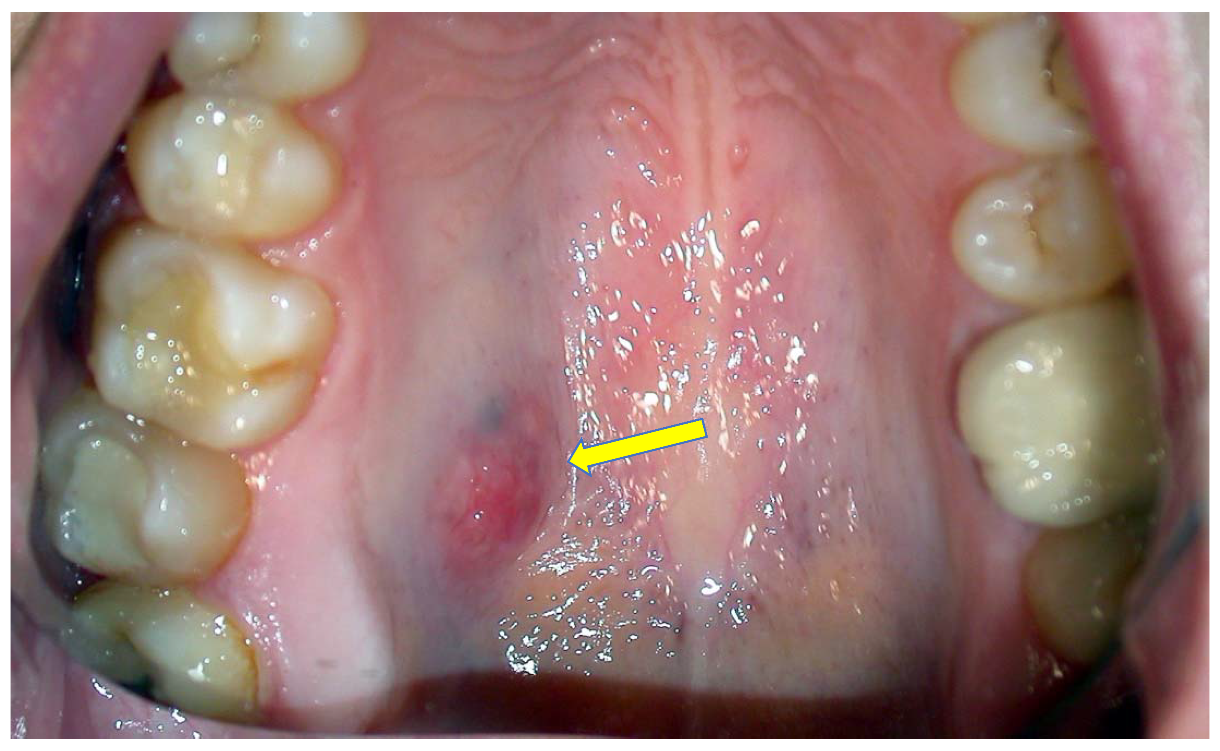 White Bump On Tongue Cancer