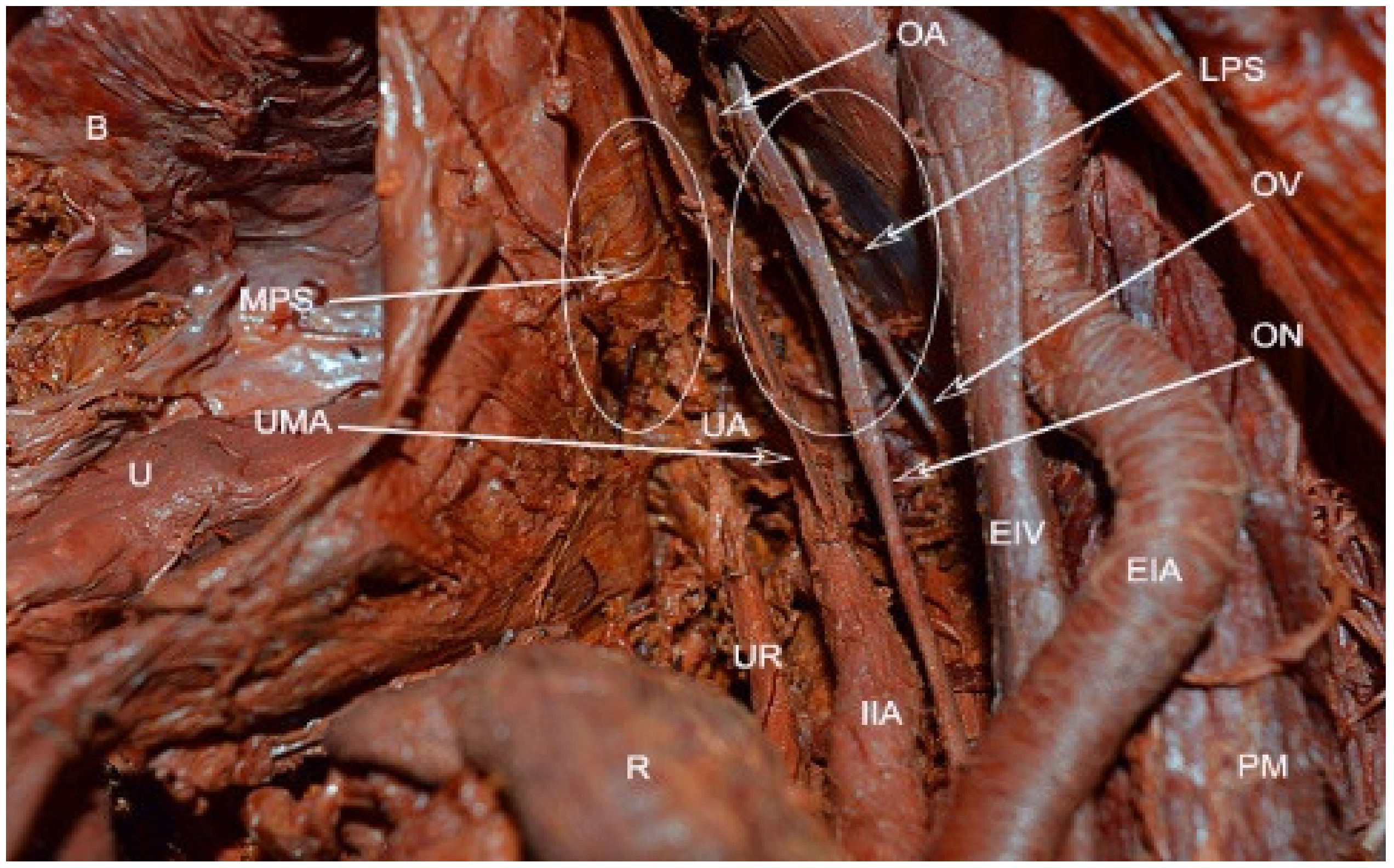 JCM | Free Full-Text | Avascular Spaces of the Female Pelvis—Clinical