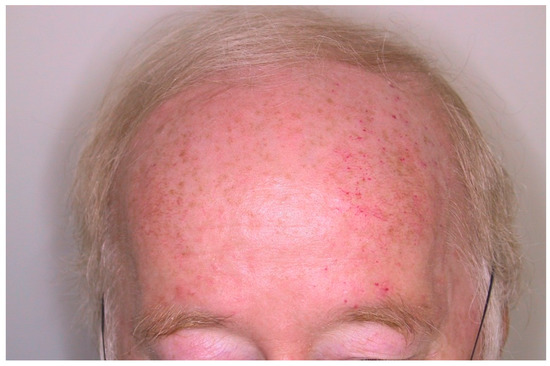 JCM | Topical Collection : Hereditary Hemorrhagic Telangiectasia ...