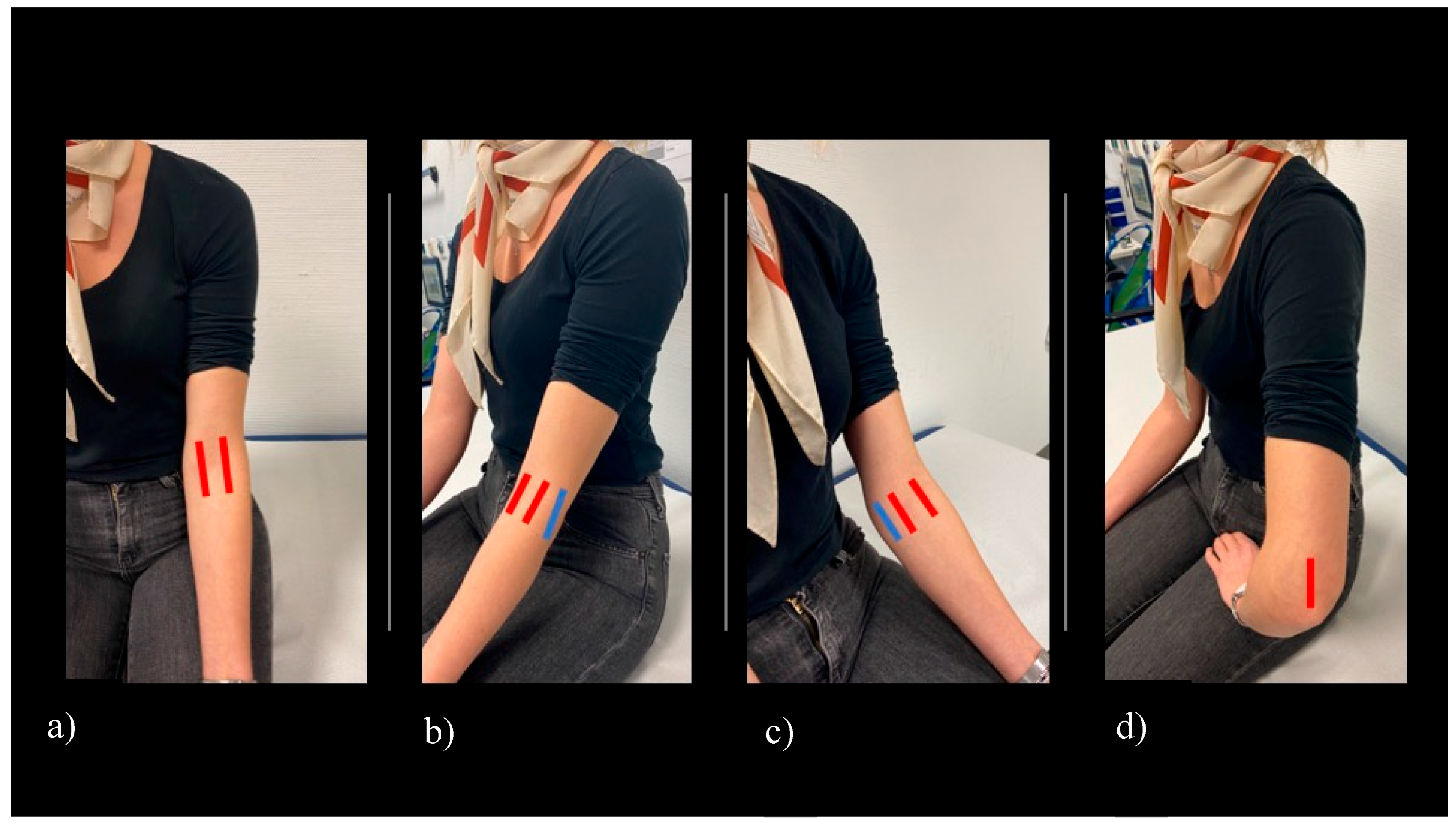 JCM Free FullText Prevalence of Elbow Joint Arthritis and