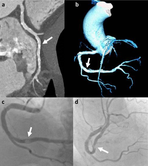 Combined Coronary CT-Angiography and TAVI-Planning: A Contrast ..., حجم الصورة 492x550