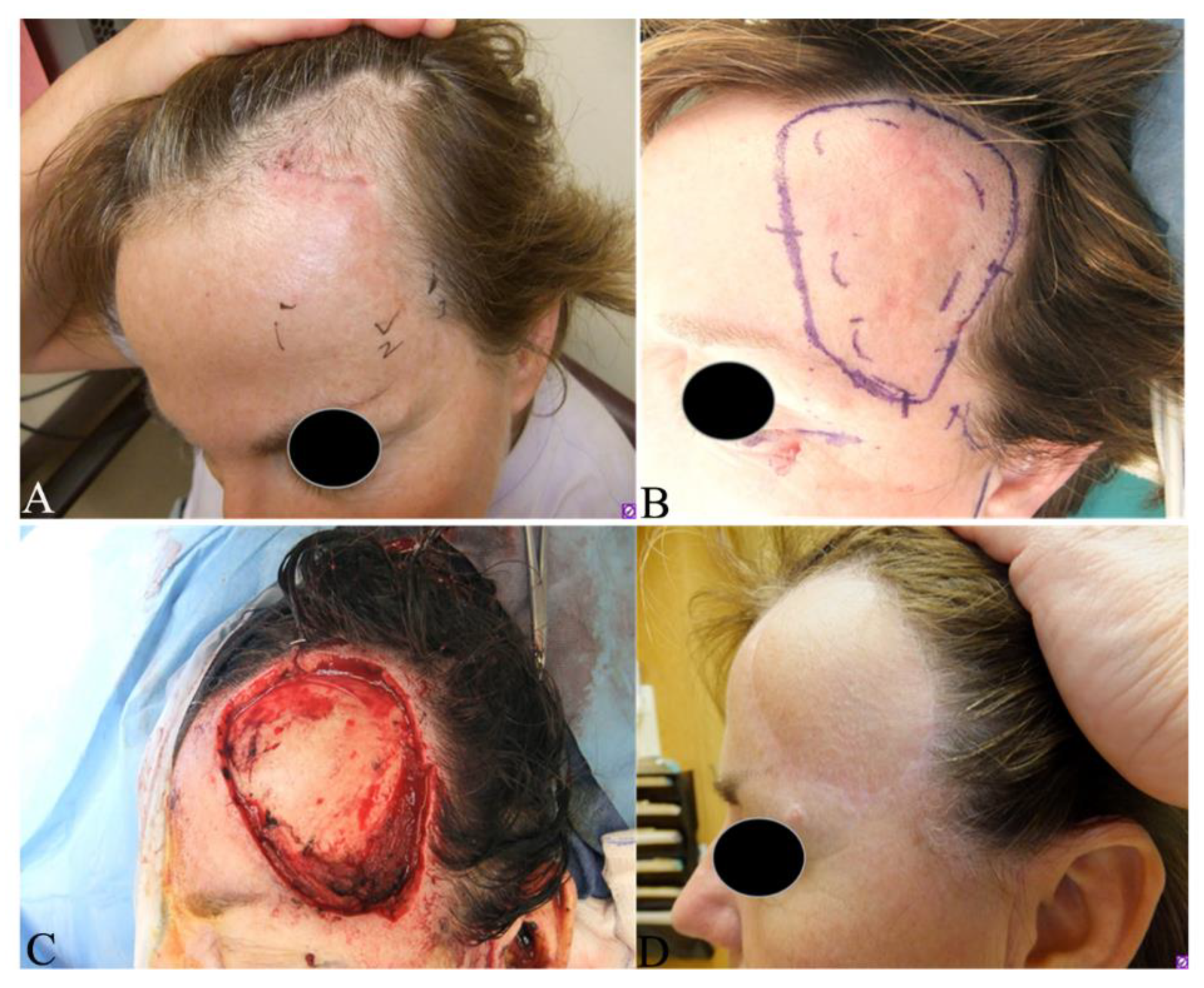 sarcoma cancer forehead)