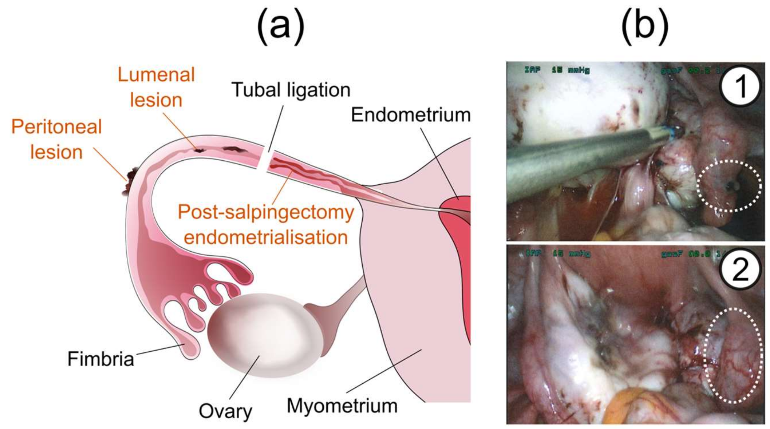 JCM | Free Full-Text | Endometriosis and the Fallopian Tubes: Theories of  Origin and Clinical Implications