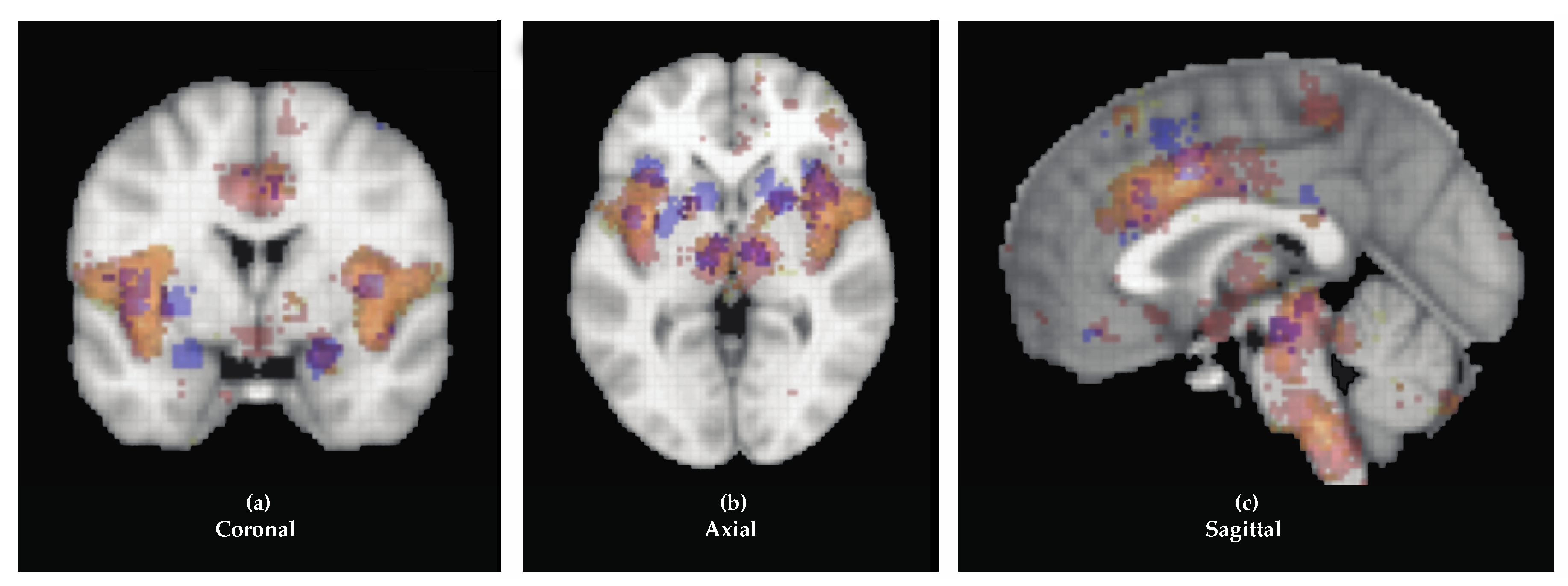 Jcm Free Full Text The Cerebral Localization Of Pain Anatomical And Functional Considerations For Targeted Electrical Therapies Html