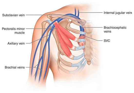 JCM | Free Full-Text | Diagnostic and Therapeutic Management of Upper Extremity Deep Vein Thrombosis | HTML JCM | Free Full-Text | Diagnostic and Therapeutic Management of Upper Extremity Deep Vein Thrombosis | HTML