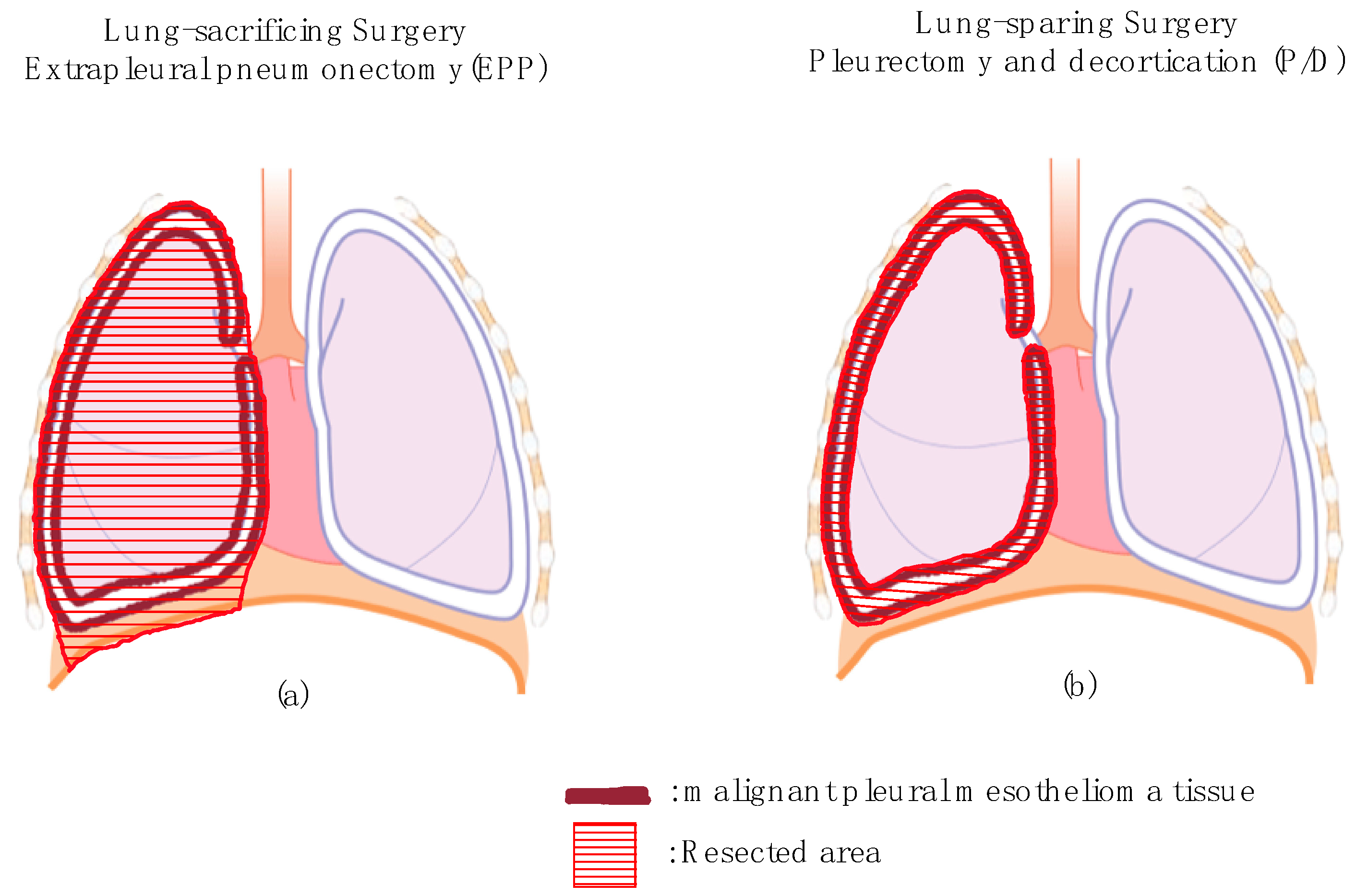 stage ii papillary thyroid cancer