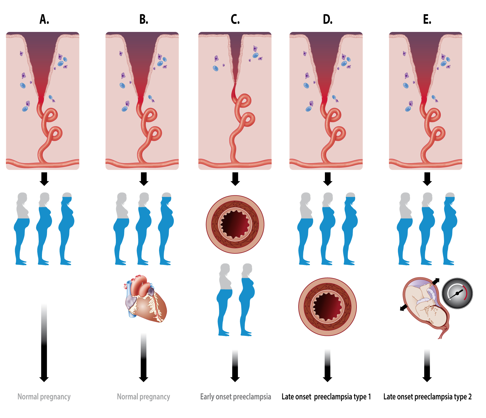 Preeclampsia Pathophysiology Diagram