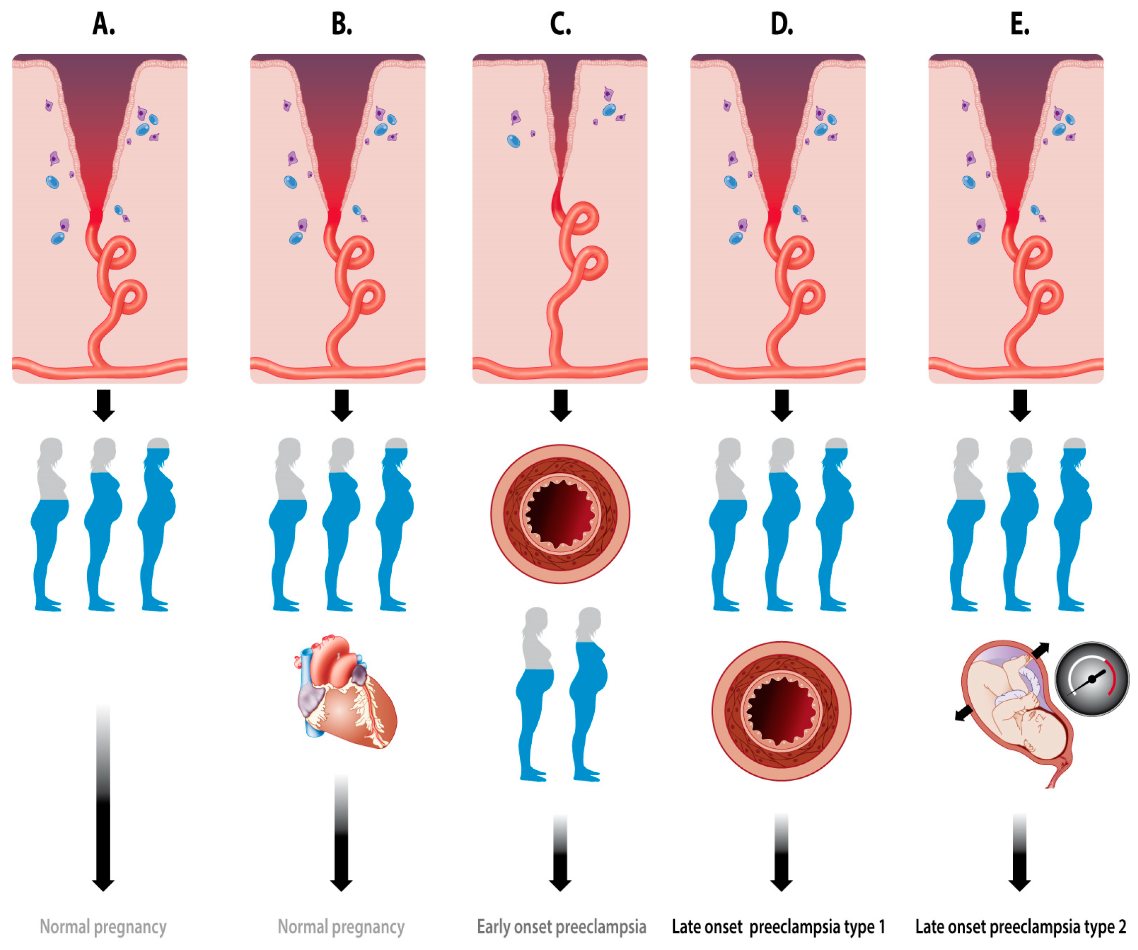 Guideline No. 426: Hypertensive Disorders of Pregnancy: Diagnosis,  Prediction, Prevention, and Management - Journal of Obstetrics and  Gynaecology Canada